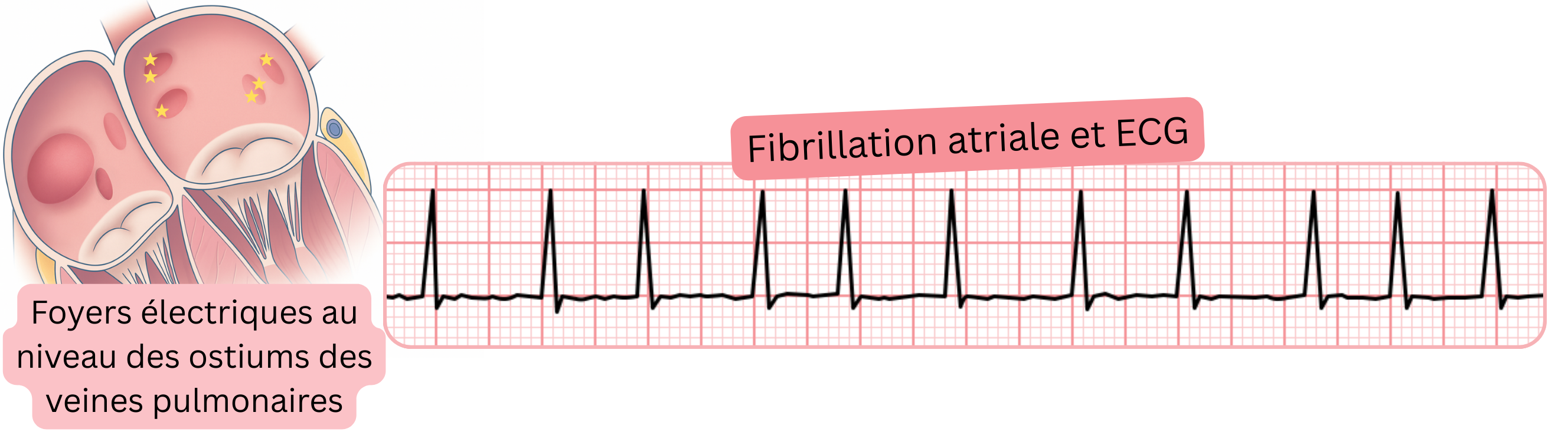 Illustration de la fibrillation atriale à l’ECG mettant en évidence des foyers électriques au niveau des ostiums des veines pulmonaires comme déclencheurs de l’arythmie.