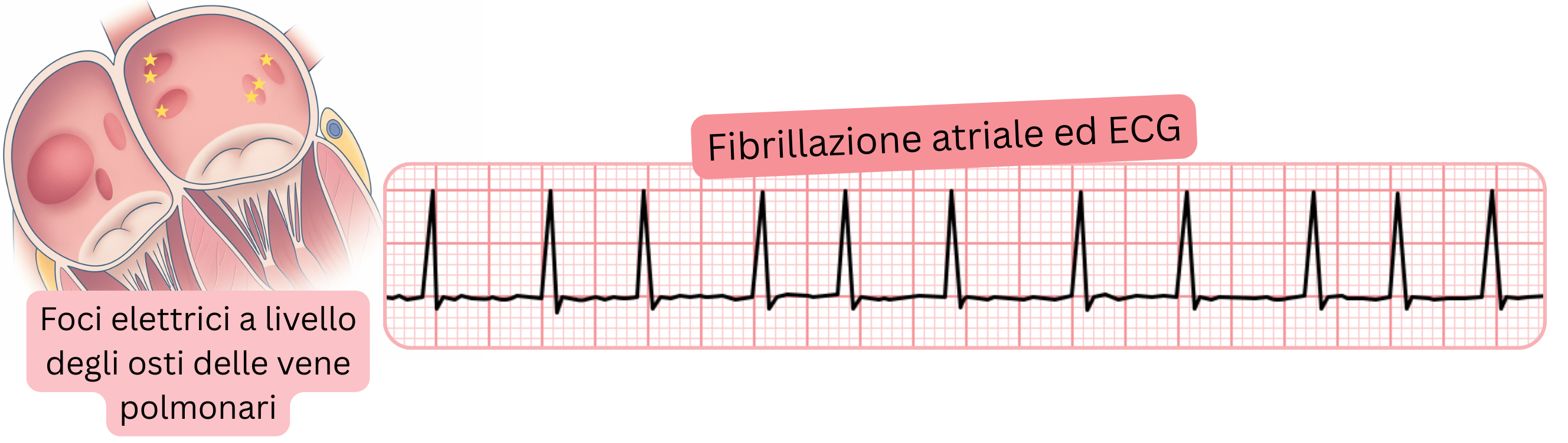 Illustrazione della fibrillazione atriale all’ECG con evidenziazione dei foci elettrici a livello degli osti delle vene polmonari come fattori scatenanti dell’aritmia.