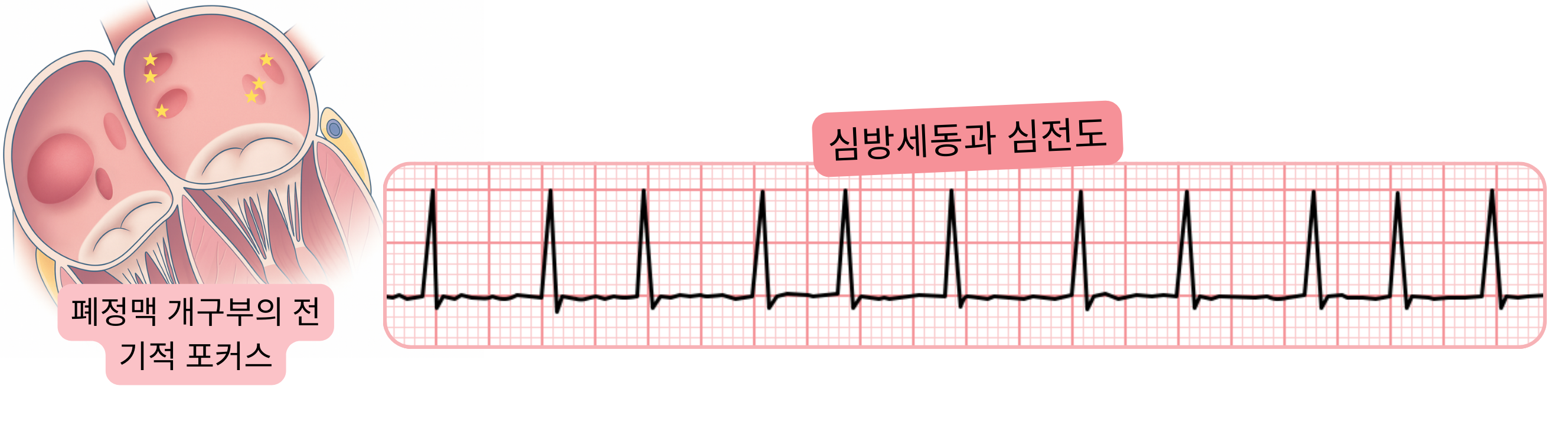 심전도에서의 심방세동을 나타내며, 폐정맥 개구부의 전기적 초점이 부정맥의 유발 인자임을 보여주는 그림.