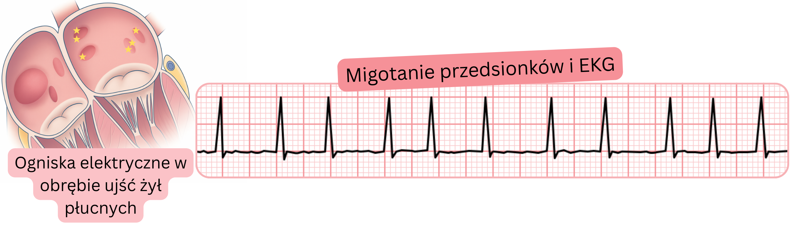 Ilustracja migotania przedsionków w EKG z uwidocznieniem ognisk elektrycznych w obrębie ujść żył płucnych jako wyzwalaczy arytmii.