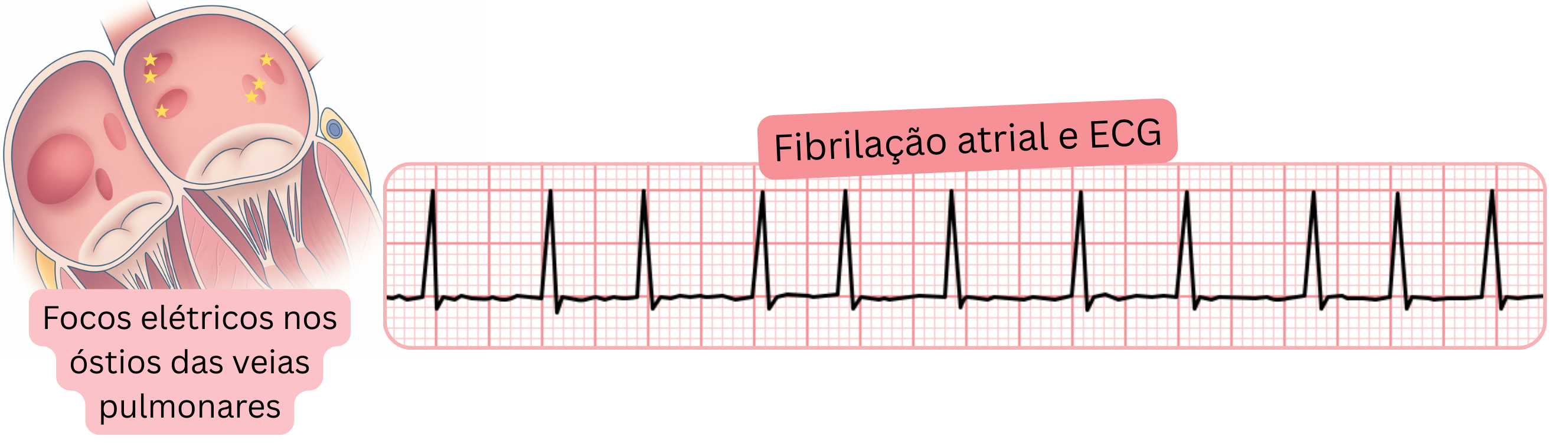 Ilustração da fibrilação atrial no ECG destacando focos elétricos nos óstios das veias pulmonares como gatilhos da arritmia.