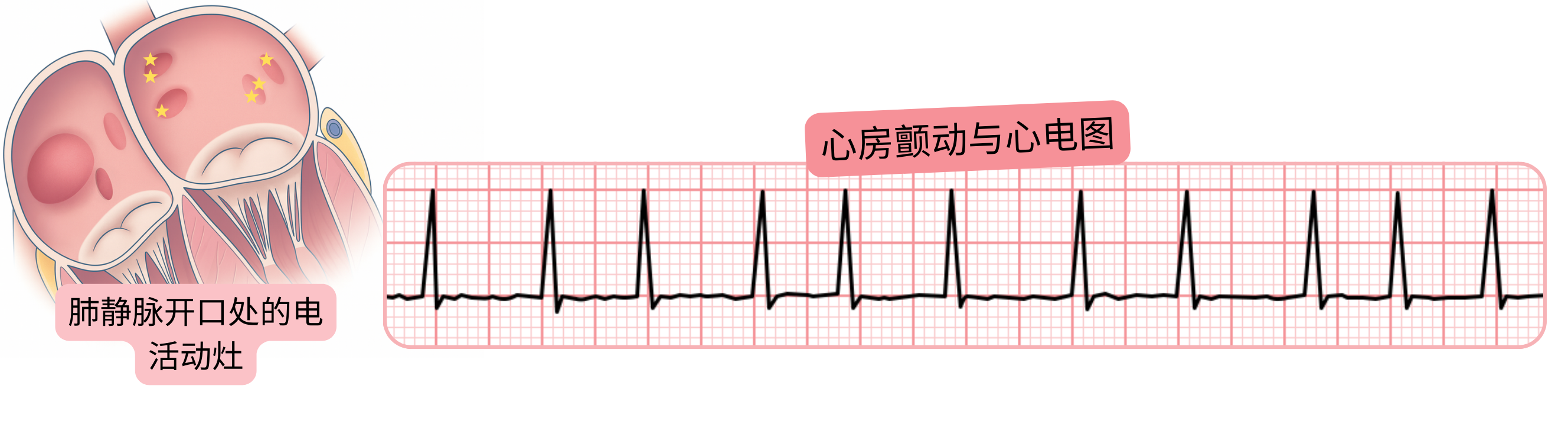 心电图中心房颤动示意图，突出显示位于肺静脉开口处的电活动灶作为心律失常的触发因素。