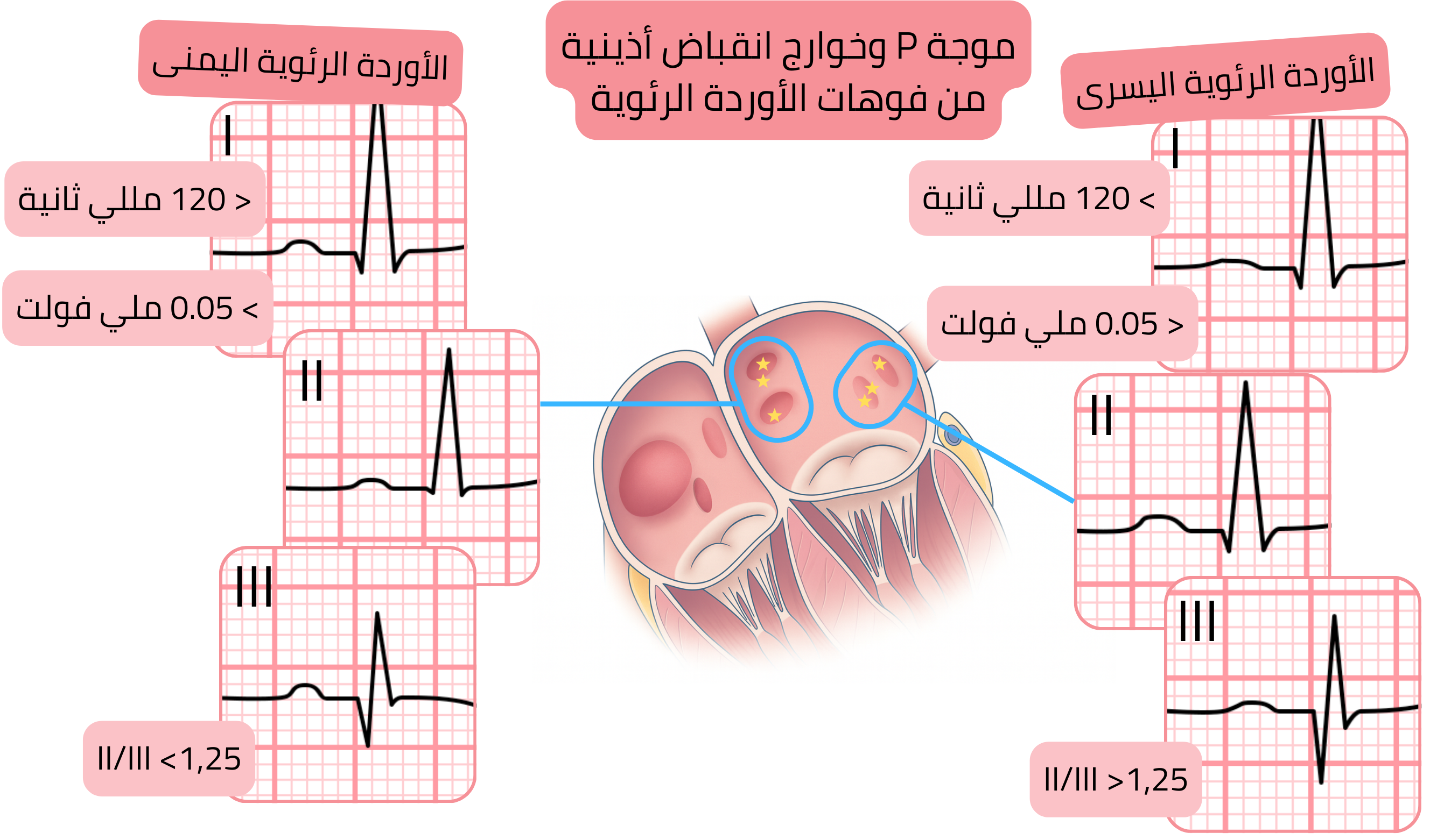 مخطط يوضح شكل موجة P والخوارج الأذينية الناشئة من فوهات الأوردة الرئوية، مع إبراز الفروق على تخطيط القلب بين الأوردة الرئوية اليمنى واليسرى.