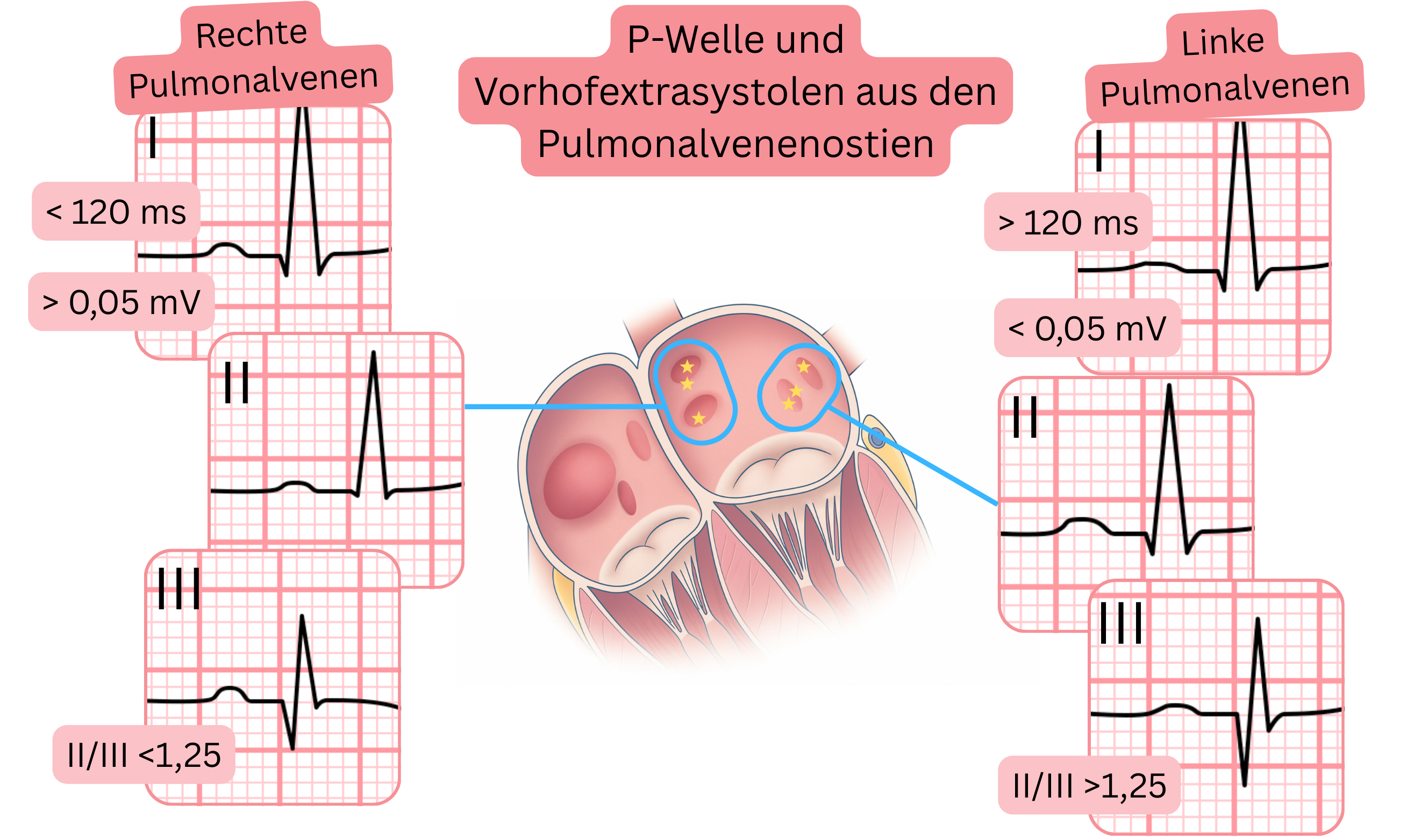Schema der P-Wellen-Morphologie und atrialer Extrasystolen aus den Ostien der Lungenvenen mit EKG-Unterschieden zwischen rechten und linken Lungenvenen.