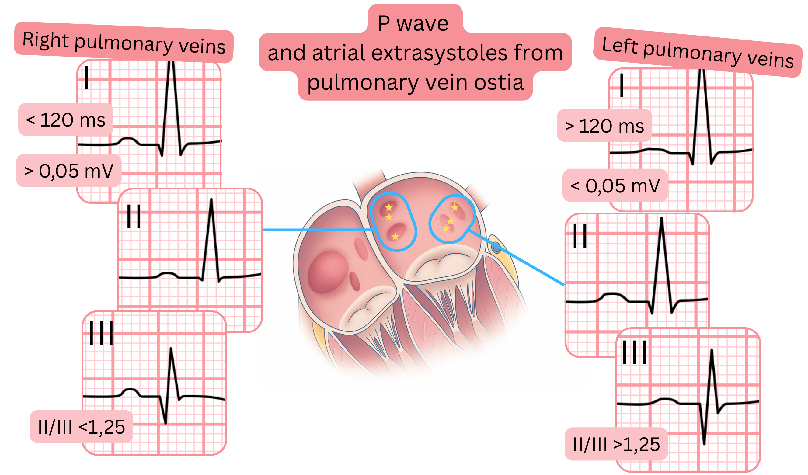 Diagram of P-wave morphology and atrial premature beats originating from pulmonary vein ostia, highlighting ECG differences between right and left pulmonary veins.