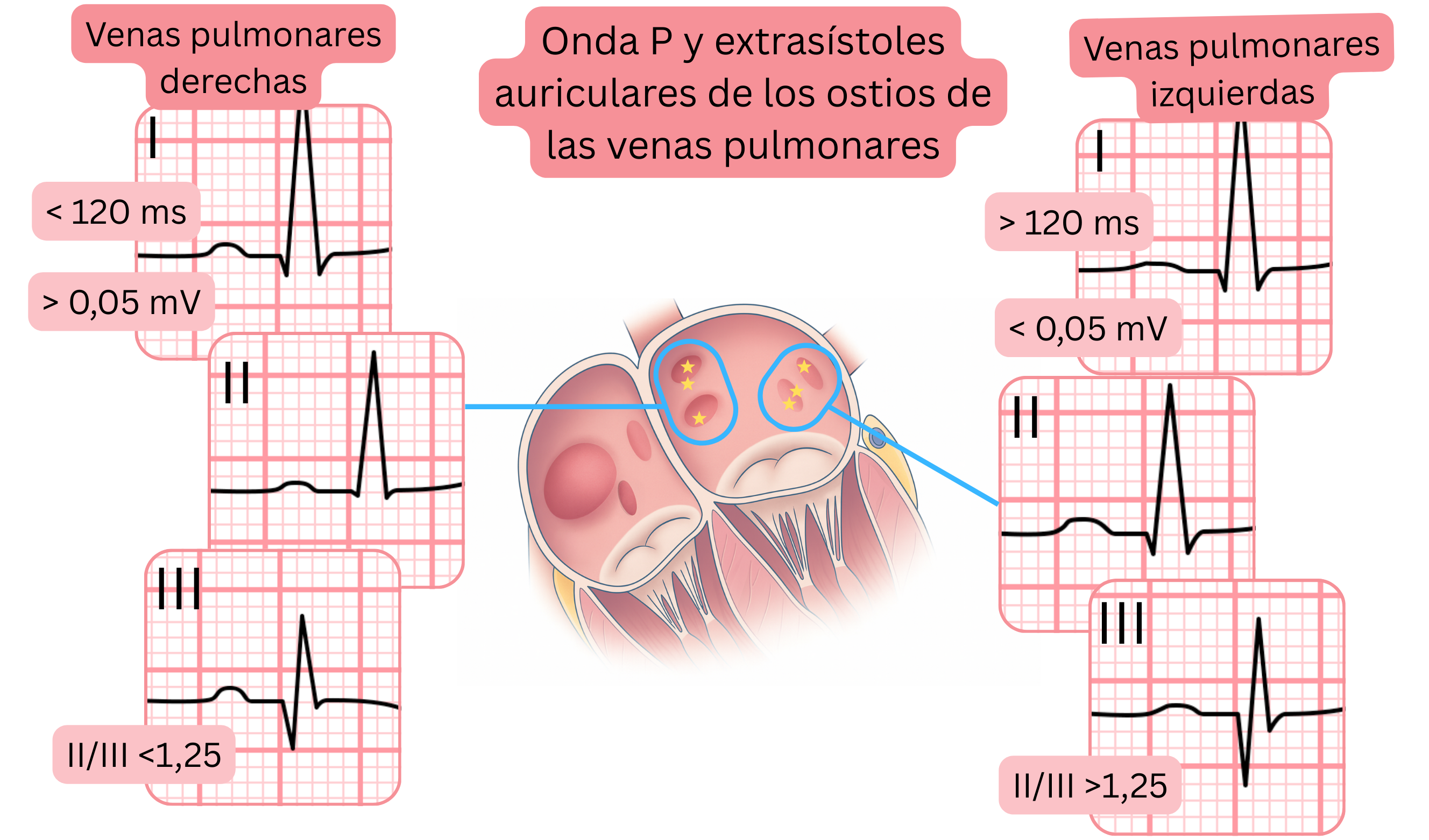 Esquema de la morfología de la onda P y de las extrasístoles auriculares originadas en los ostios de las venas pulmonares, mostrando diferencias en el ECG entre las venas pulmonares derechas e izquierdas.