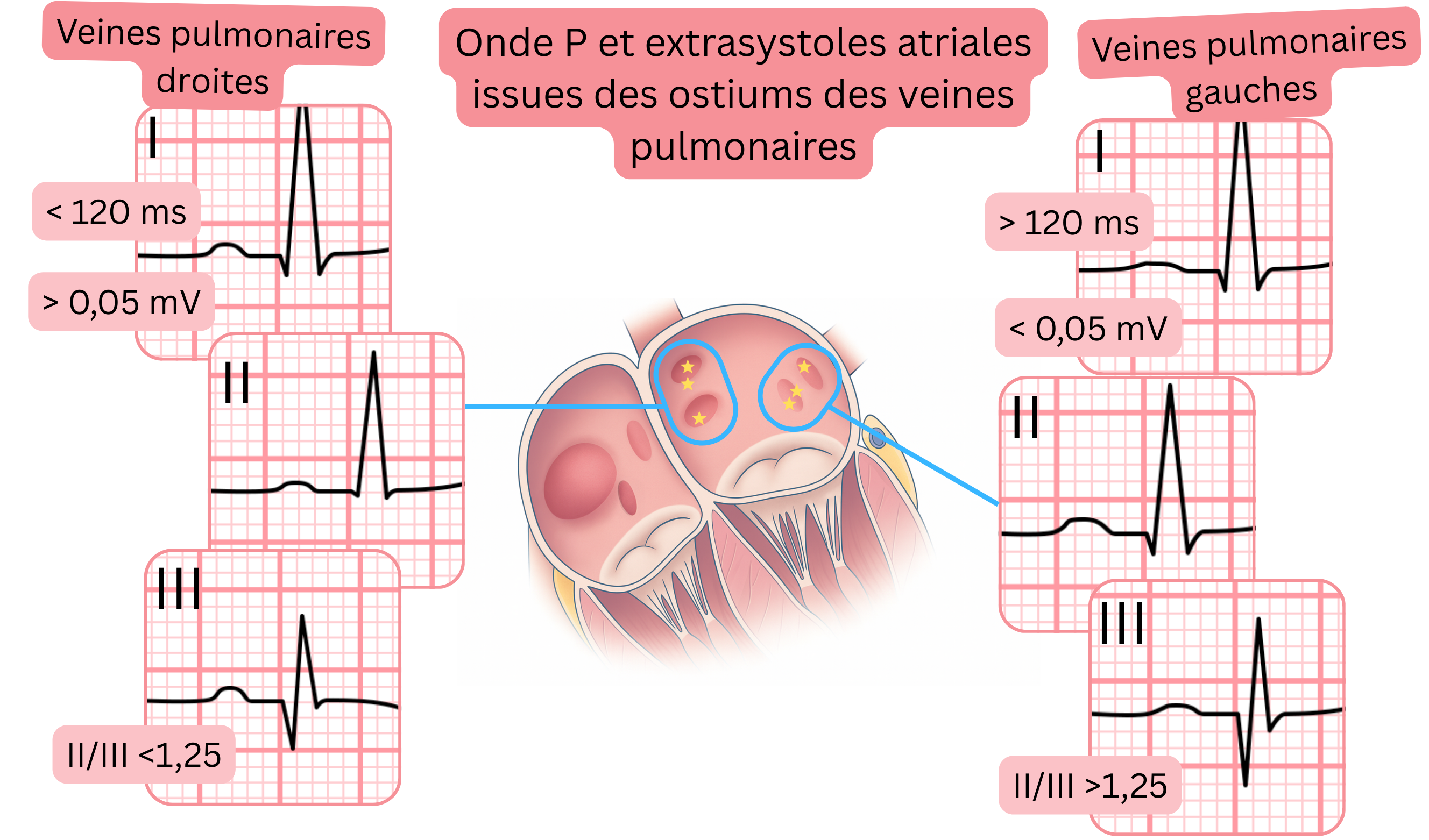 Schéma de la morphologie de l’onde P et des extrasystoles auriculaires issues des ostiums des veines pulmonaires, avec des différences ECG entre les veines pulmonaires droites et gauches.