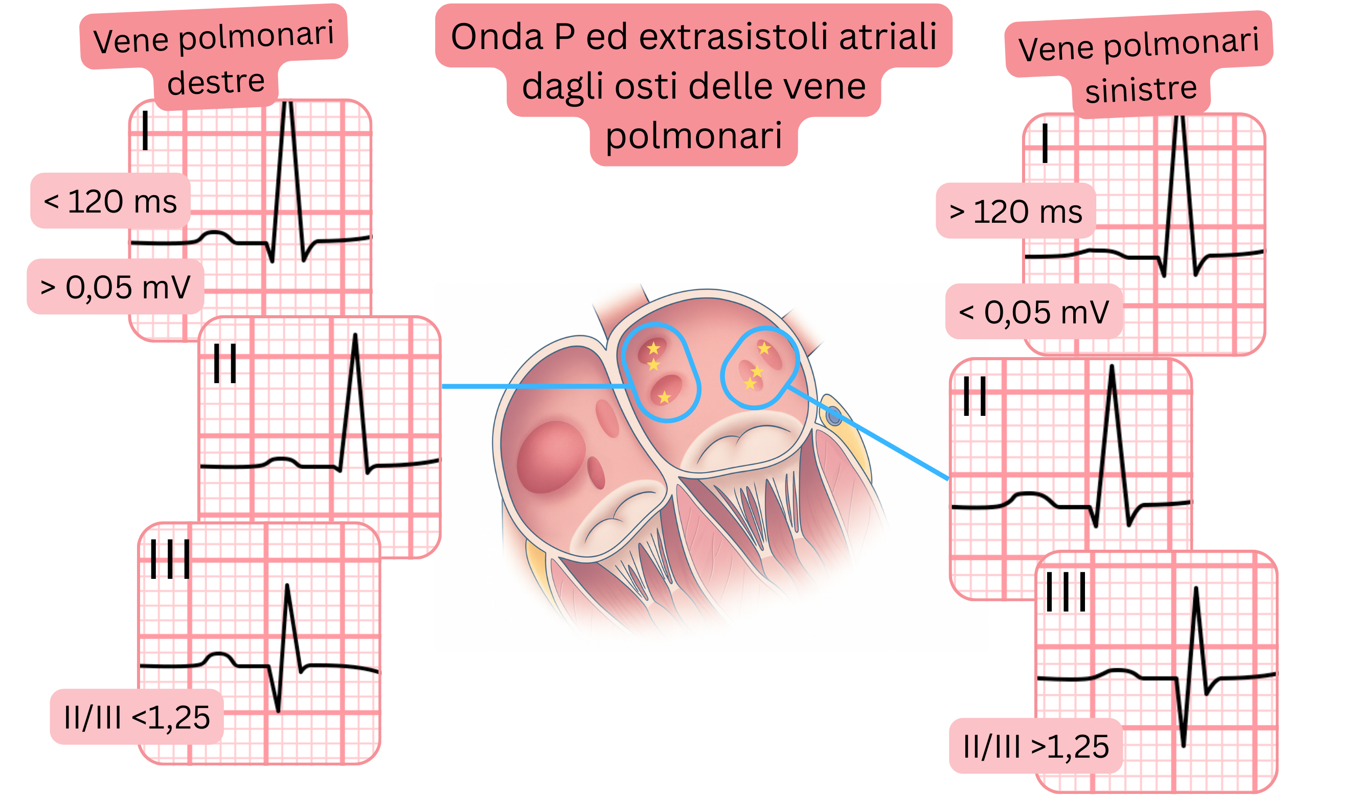 Schema della morfologia dell’onda P e delle extrasistoli atriali originate dagli osti delle vene polmonari, con differenze all’ECG tra vene polmonari destre e sinistre.