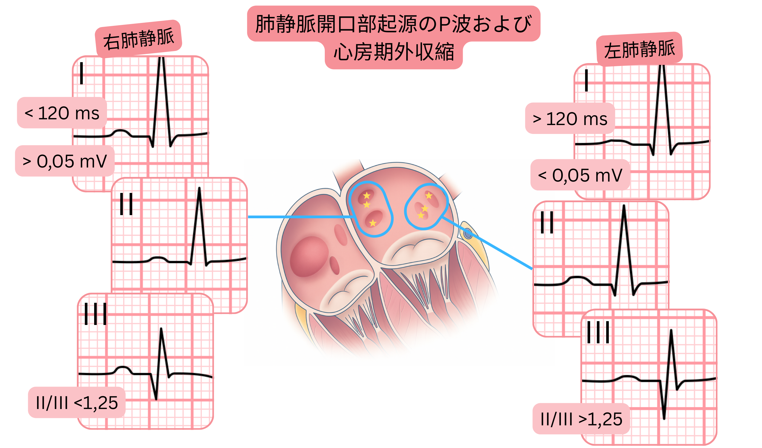 肺静脈開口部起源のP波形態および心房期外収縮を示し、心電図上で右肺静脈と左肺静脈の違いを示す模式図。