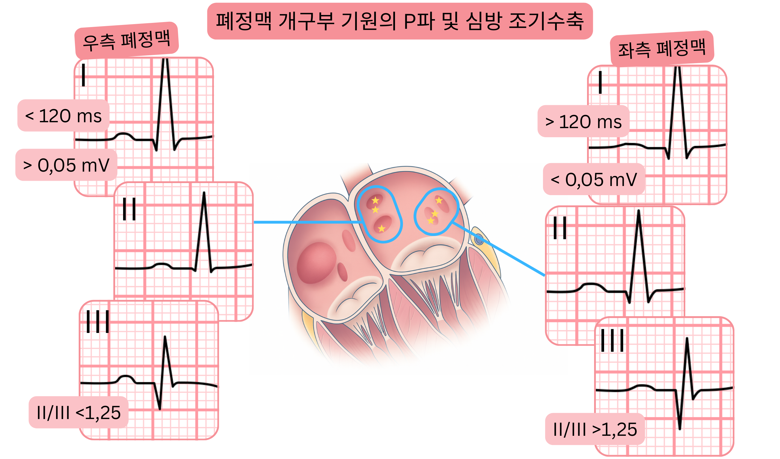 폐정맥 개구부에서 기원한 P파 형태와 심방 조기수축을 보여주며, 심전도에서 우측과 좌측 폐정맥 간의 차이를 강조한 도식.