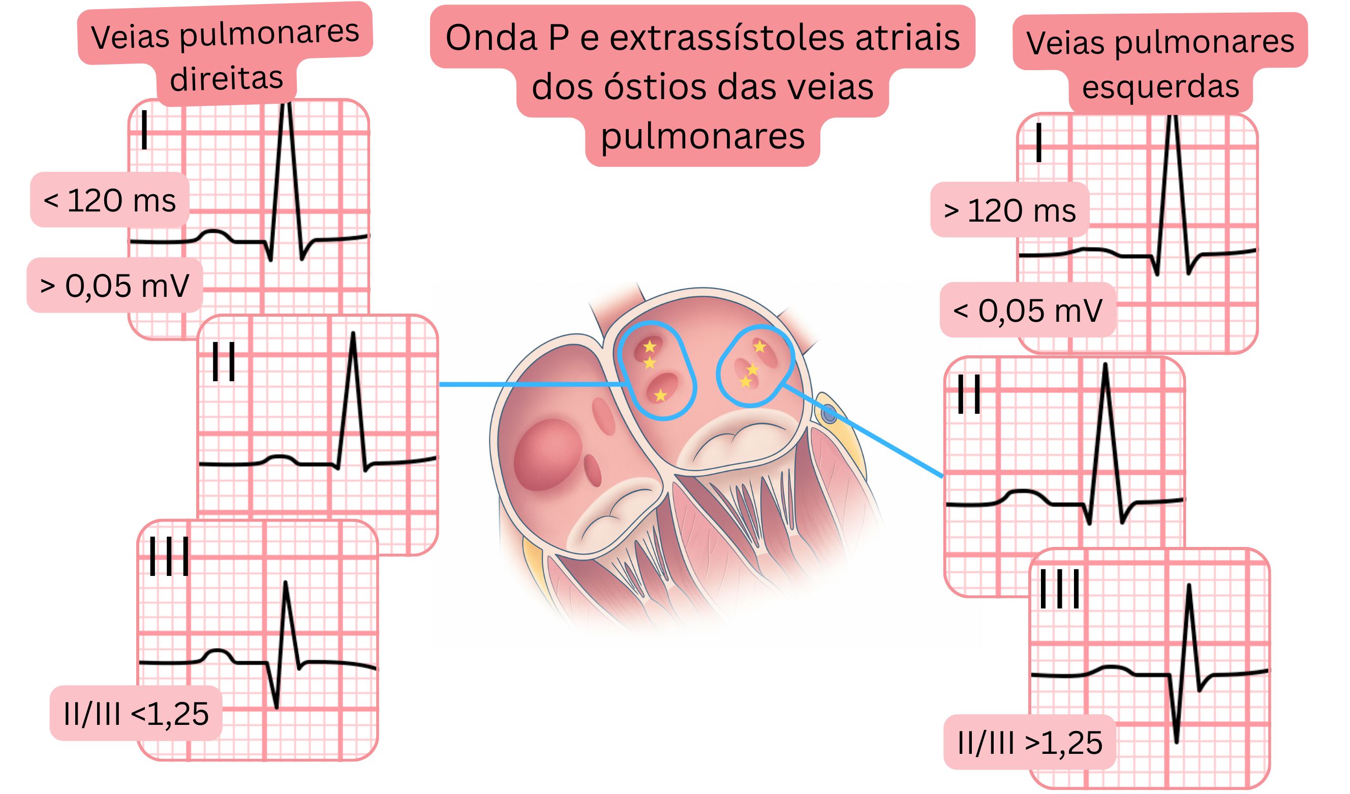 Esquema da morfologia da onda P e das extrassístoles atriais originadas nos óstios das veias pulmonares, evidenciando diferenças no ECG entre as veias pulmonares direitas e esquerdas.