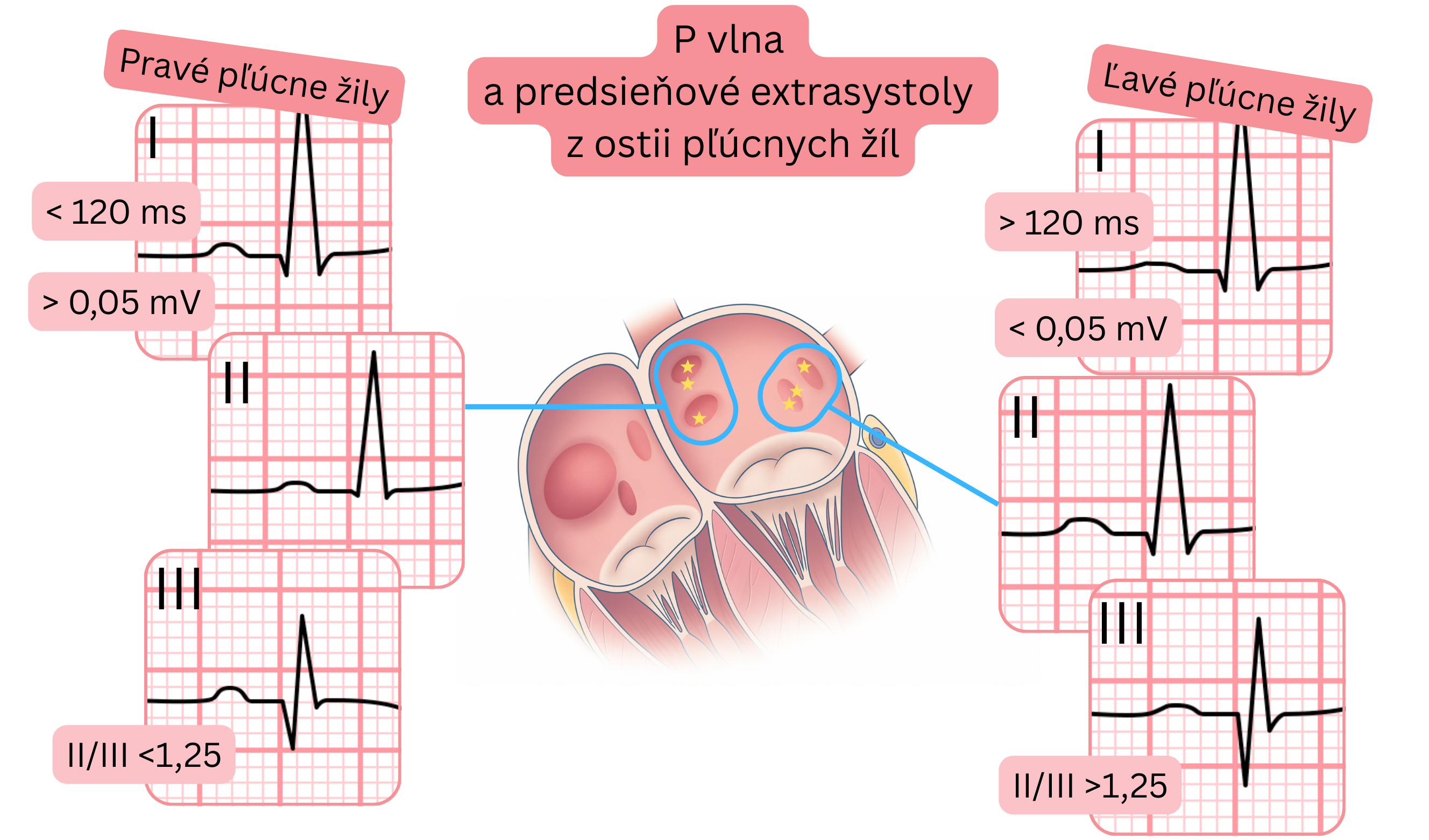 Schéma morfológie P vlny a predsieňových extrasystol z ostií pľúcnych žíl s rozdielmi medzi pravými a ľavými pľúcnymi žilami na EKG.