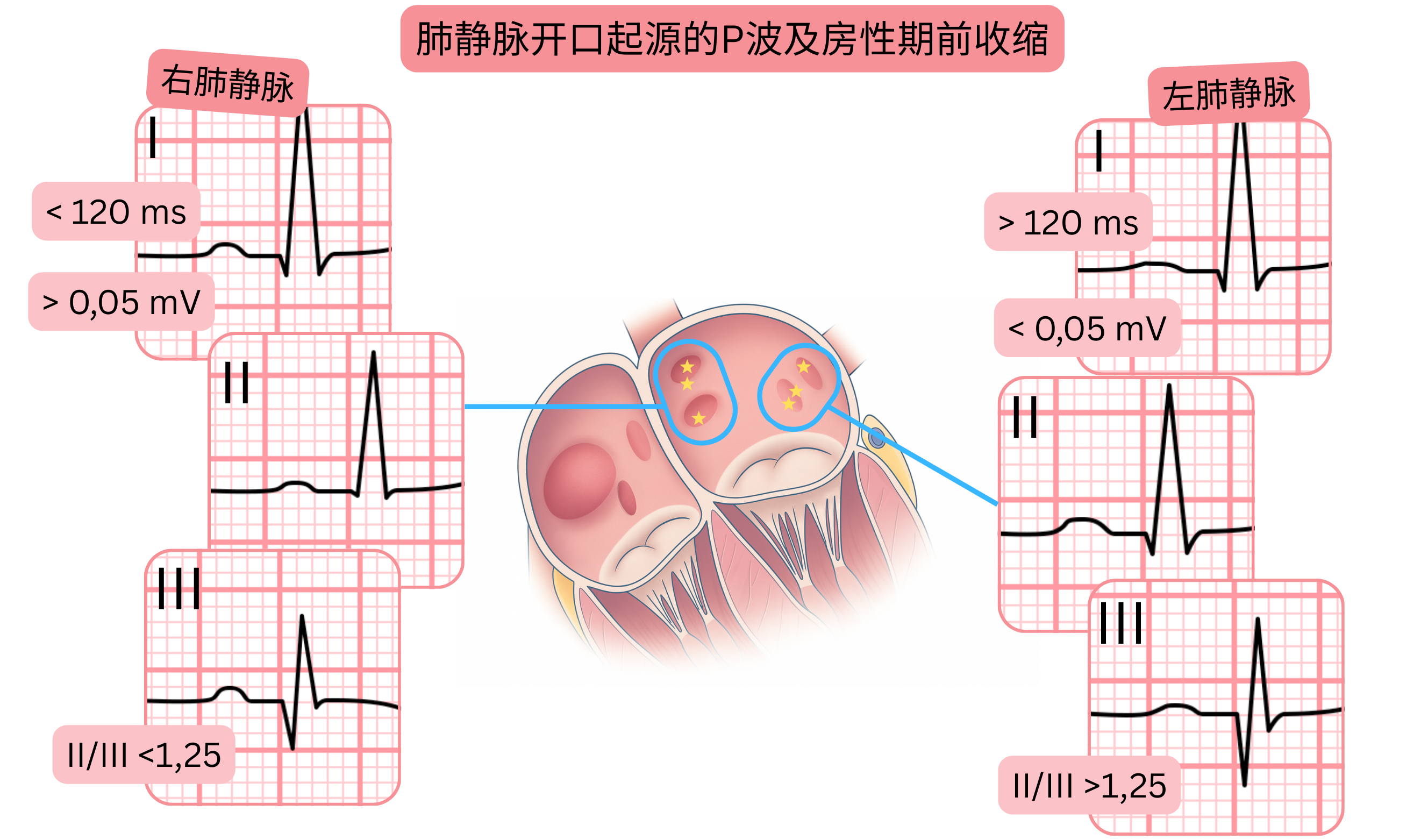 示意图展示源自肺静脉开口的P波形态及房性早搏，并强调心电图上右肺静脉与左肺静脉之间的差异。