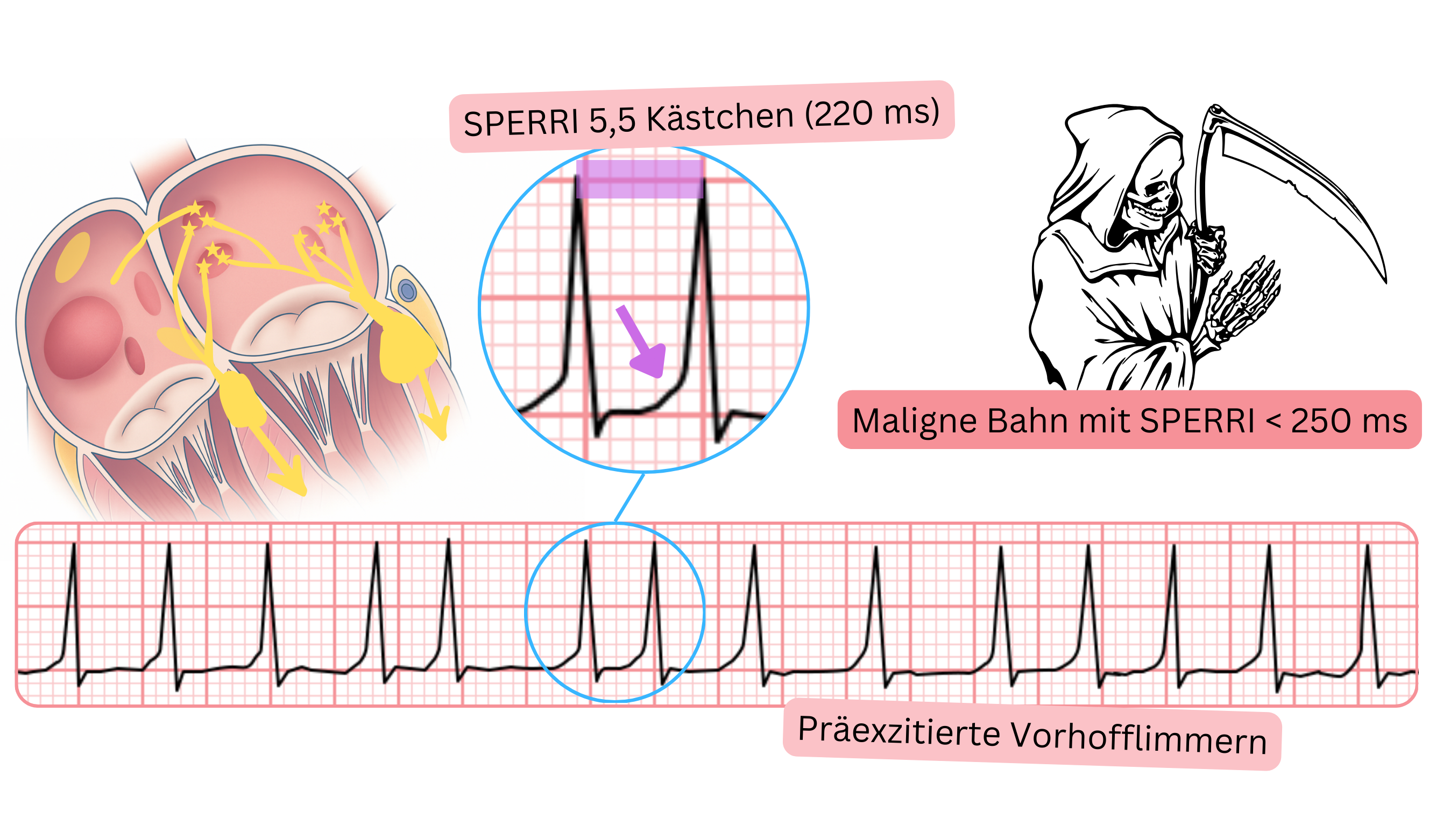 Präexzitiertes Vorhofflimmern mit kurzem SPERRI unter 250 ms und schneller ventrikulärer Antwort im EKG.