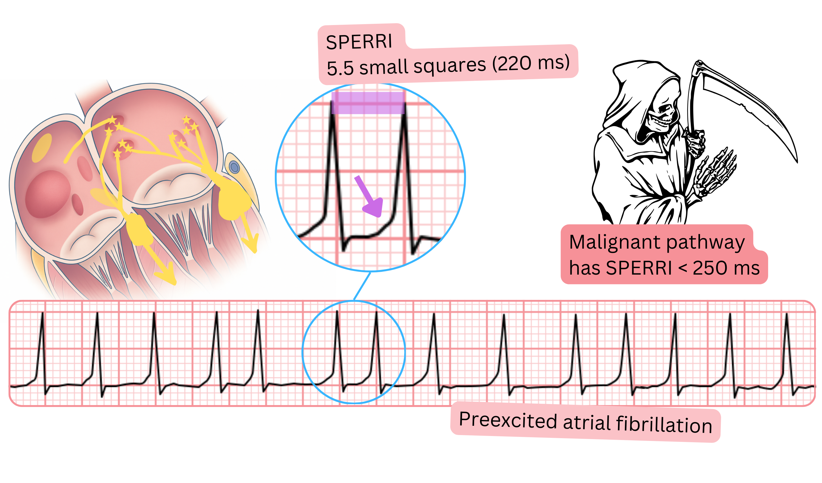 Preexcited atrial fibrillation with a short SPERRI below 250 ms and rapid ventricular response on ECG.