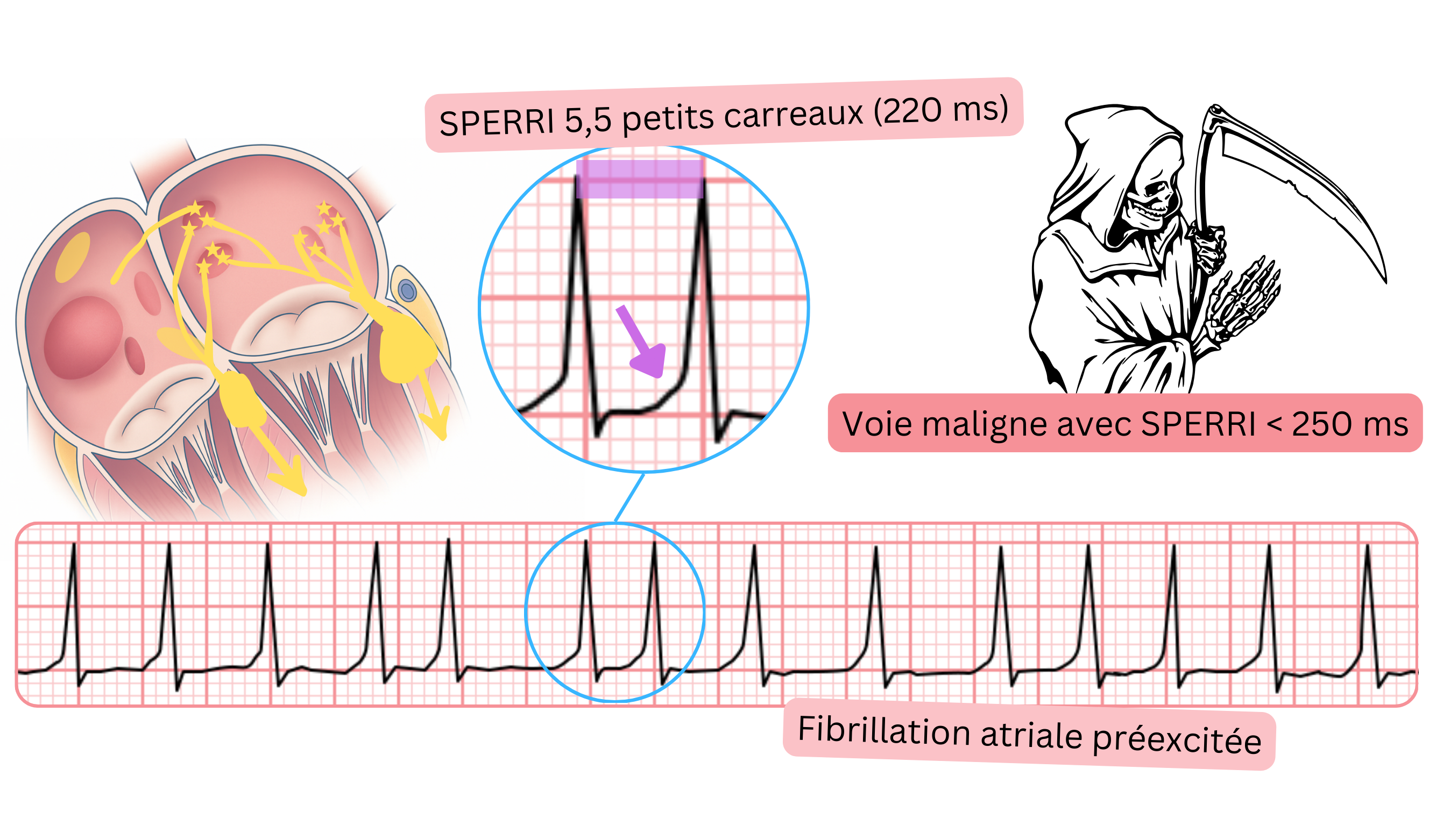 Fibrillation atriale préexcitée avec un SPERRI court inférieur à 250 ms et une réponse ventriculaire rapide à l’ECG.