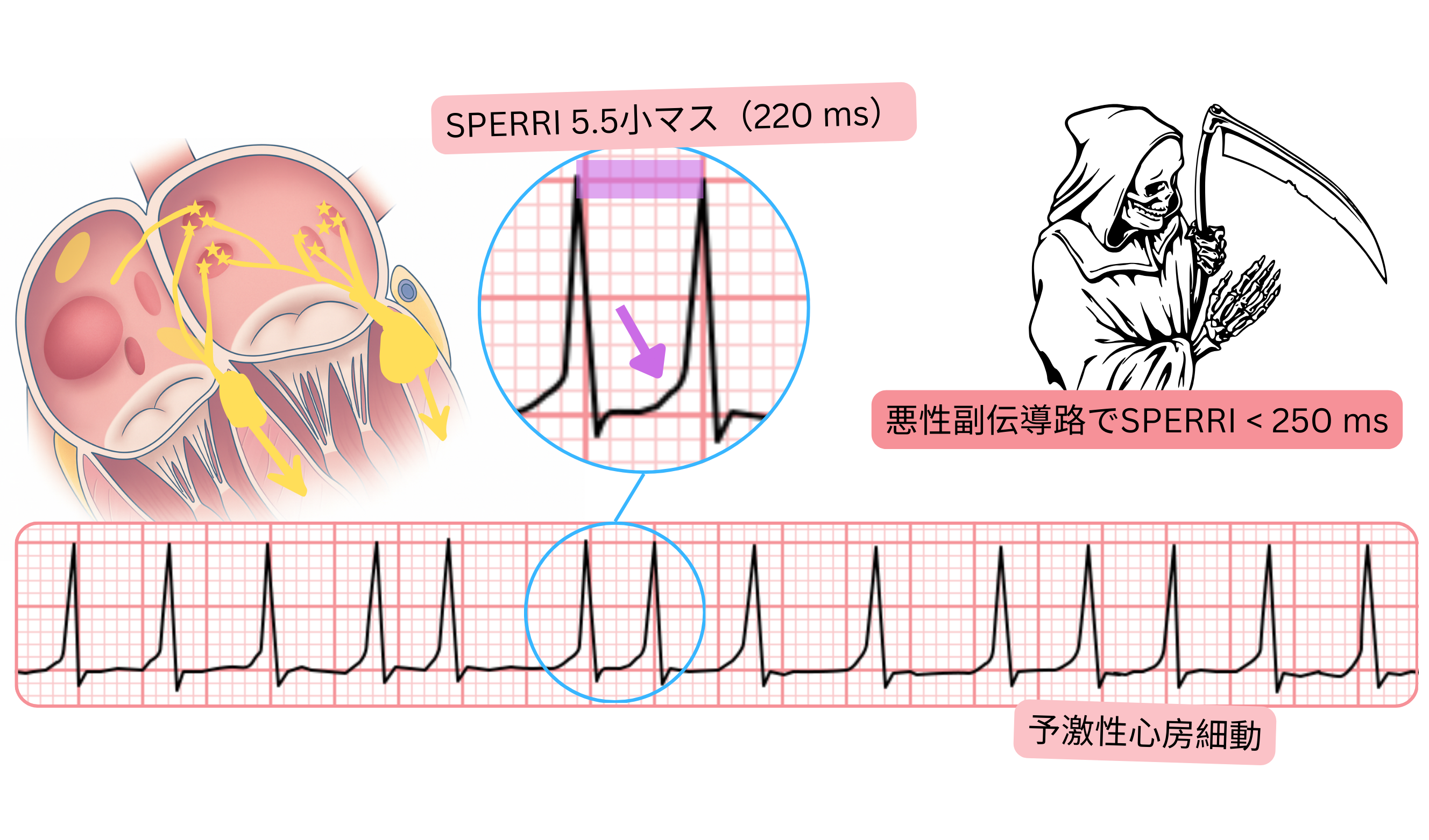 SPERRIが250ミリ秒未満の予激性心房細動で、心電図上に速い心室応答を示す。