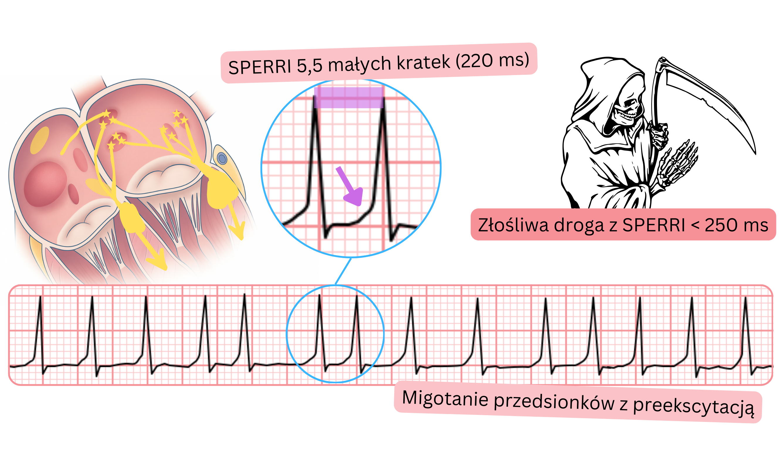 Preekscytowane migotanie przedsionków z krótkim SPERRI poniżej 250 ms i szybką odpowiedzią komorową w EKG.