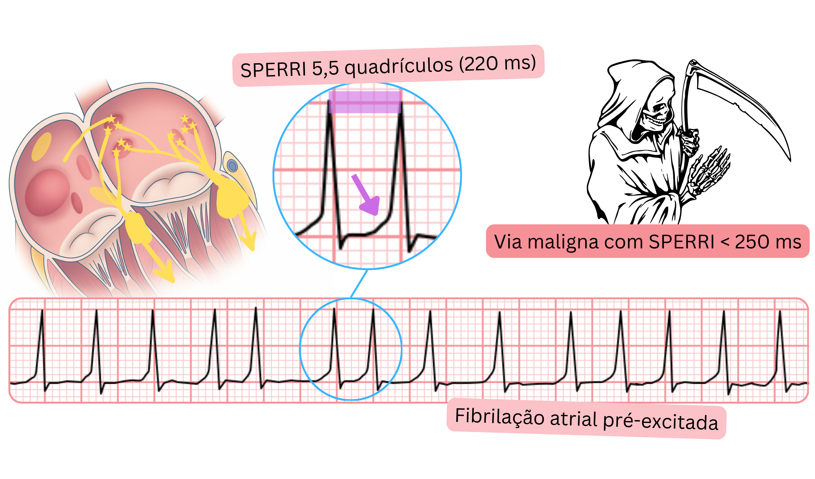 Fibrilação atrial pré-excitada com SPERRI curto inferior a 250 ms e resposta ventricular rápida no ECG.