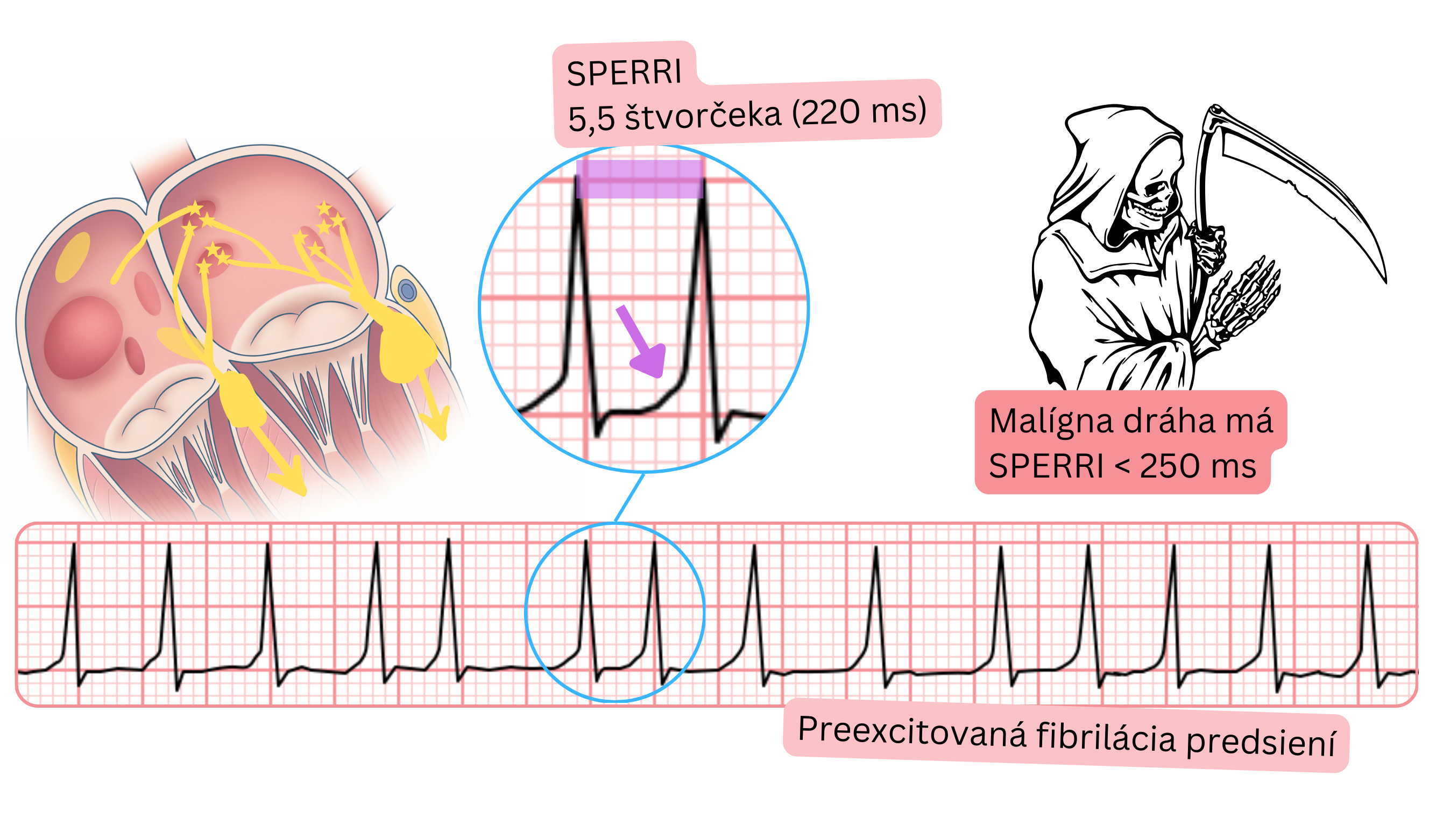 Preexcitovaná fibrilácia predsiení s krátkym SPERRI pod 250 ms a rýchlou komorovou odpoveďou na EKG.