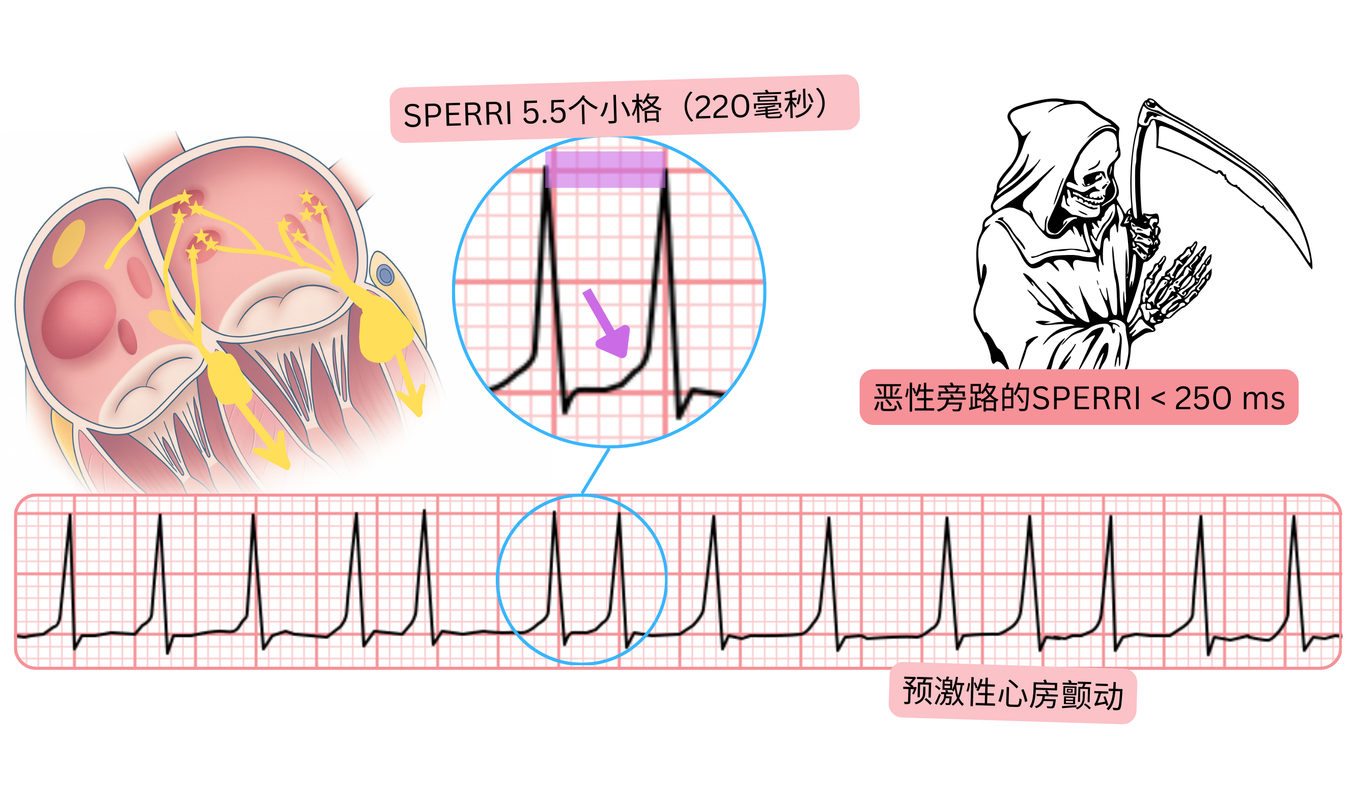 预激性心房颤动，SPERRI小于250毫秒，并在心电图上表现为快速心室反应。