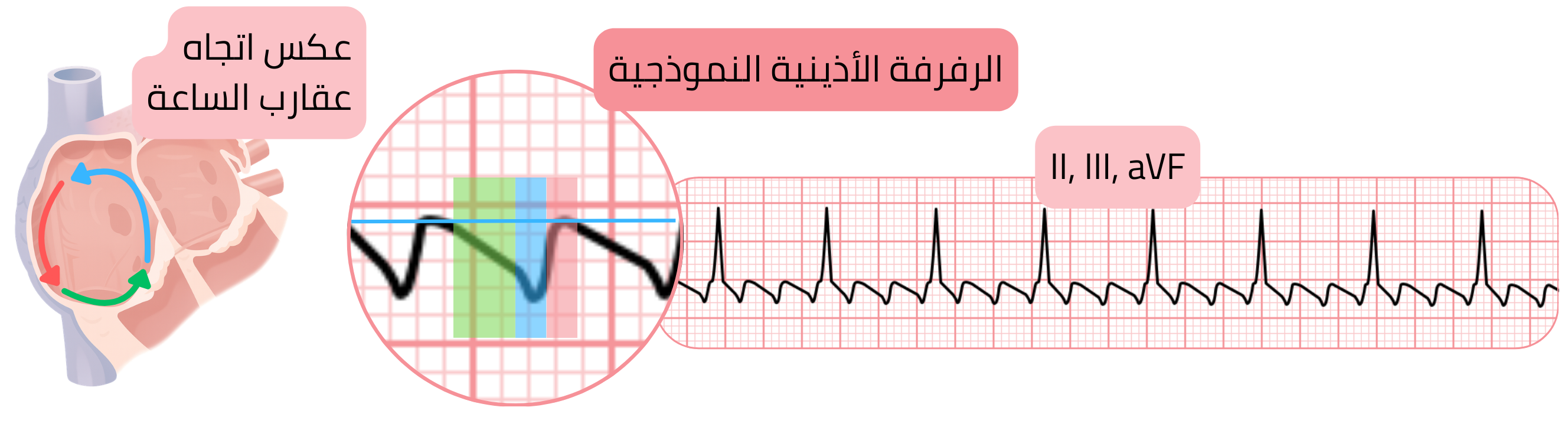 مخطط للرفرفة الأذينية النموذجية مع دائرة عودة الدخول بعكس اتجاه عقارب الساعة وموجات رفرفة مسننة مميزة في اشتقاقات تخطيط القلب II وIII وaVF.