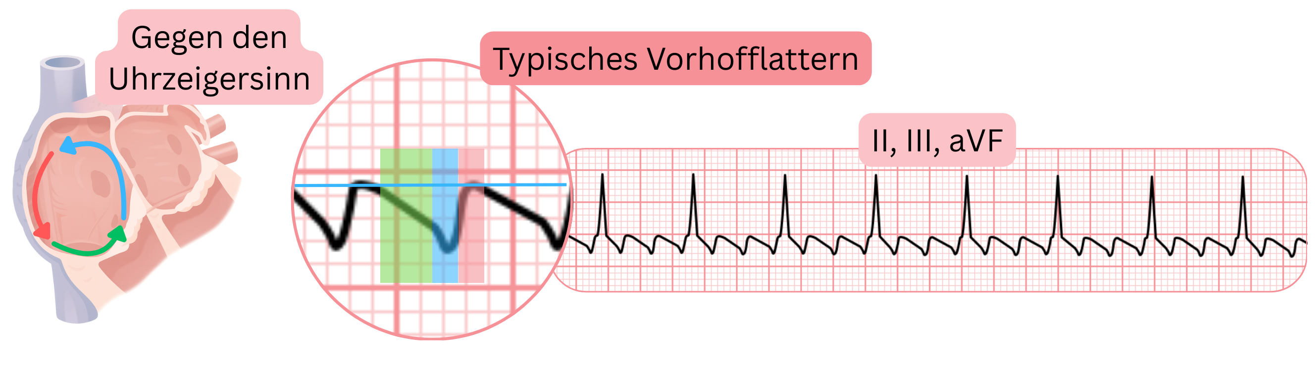 Schema des typischen Vorhofflatterns mit gegen den Uhrzeigersinn verlaufendem Reentry-Kreis und charakteristischen sägezahnförmigen Flatterwellen in den EKG-Ableitungen II, III und aVF.