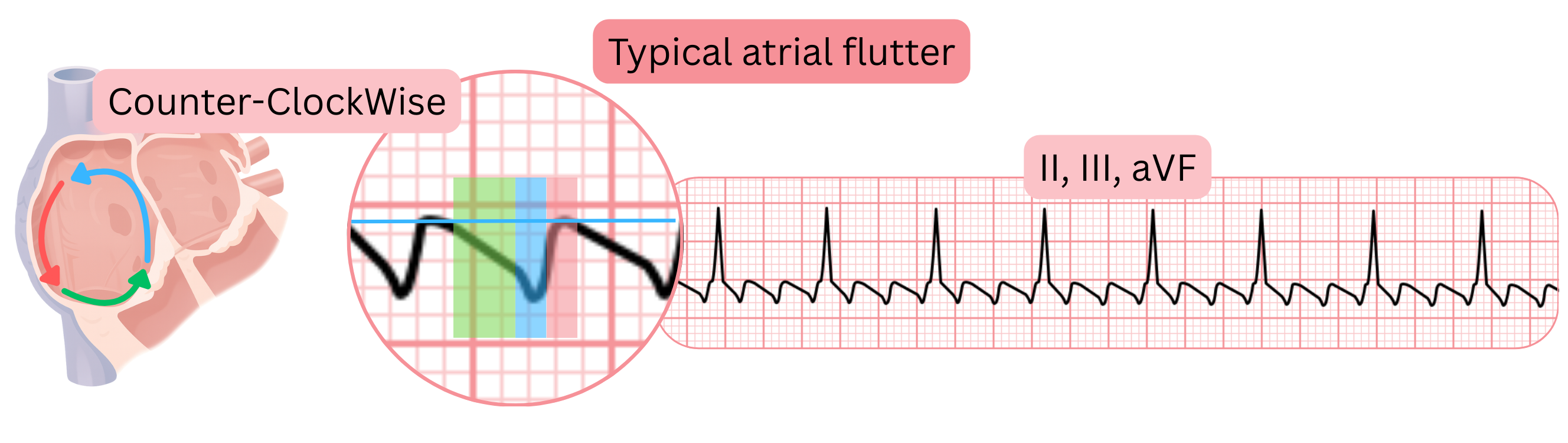 Diagram of typical atrial flutter with a counterclockwise reentry circuit and characteristic sawtooth flutter waves in ECG leads II, III, and aVF.