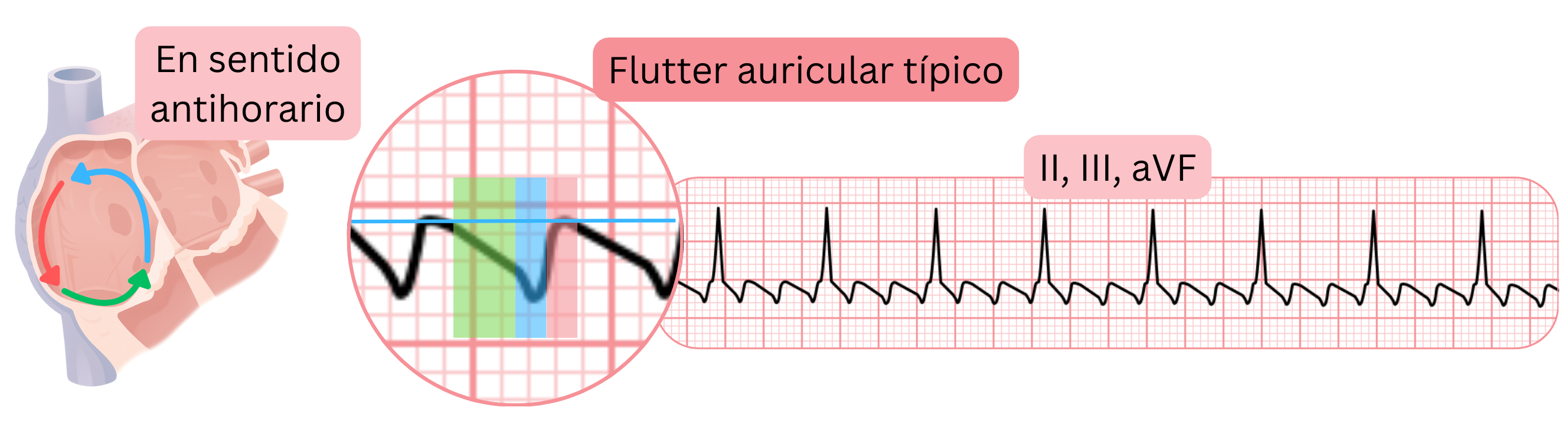 Esquema del flutter auricular típico con circuito de reentrada antihorario y ondas de flutter en dientes de sierra características en las derivaciones II, III y aVF del ECG.