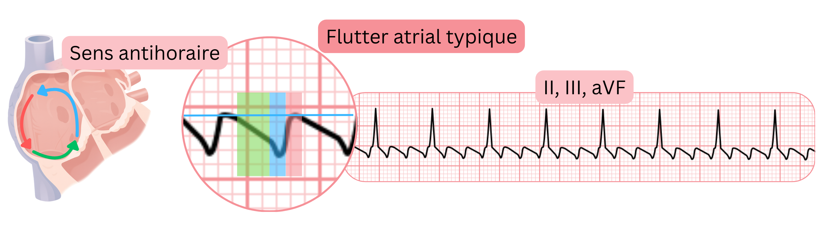 Schéma du flutter auriculaire typique avec un circuit de réentrée antihoraire et des ondes de flutter en dents de scie caractéristiques dans les dérivations ECG II, III et aVF.