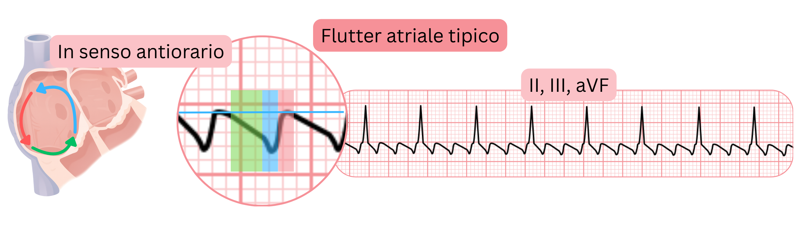 Schema del flutter atriale tipico con circuito di rientro antiorario e caratteristiche onde di flutter a dente di sega nelle derivazioni ECG II, III e aVF.