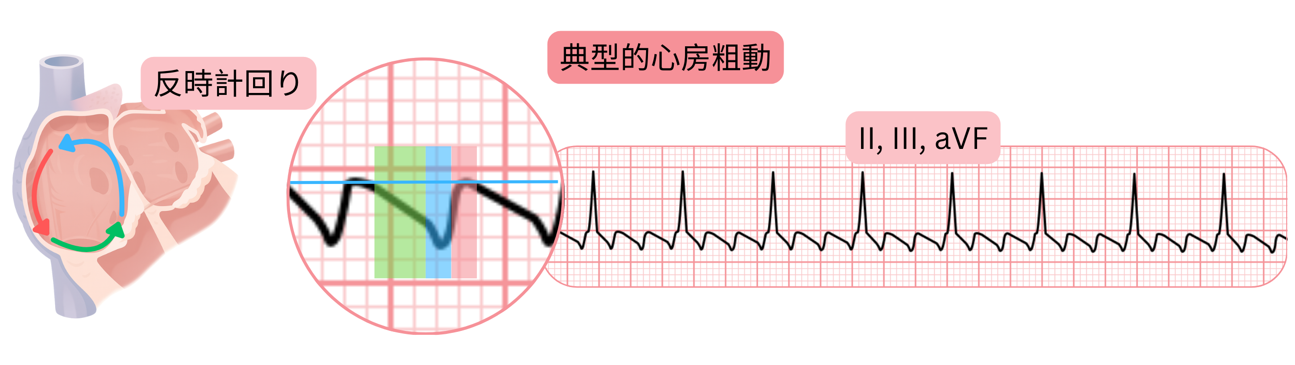 反時計回りのリエントリー回路を伴う典型的心房粗動の模式図で、心電図II、III、aVF誘導に特徴的な鋸歯状の粗動波を示す。