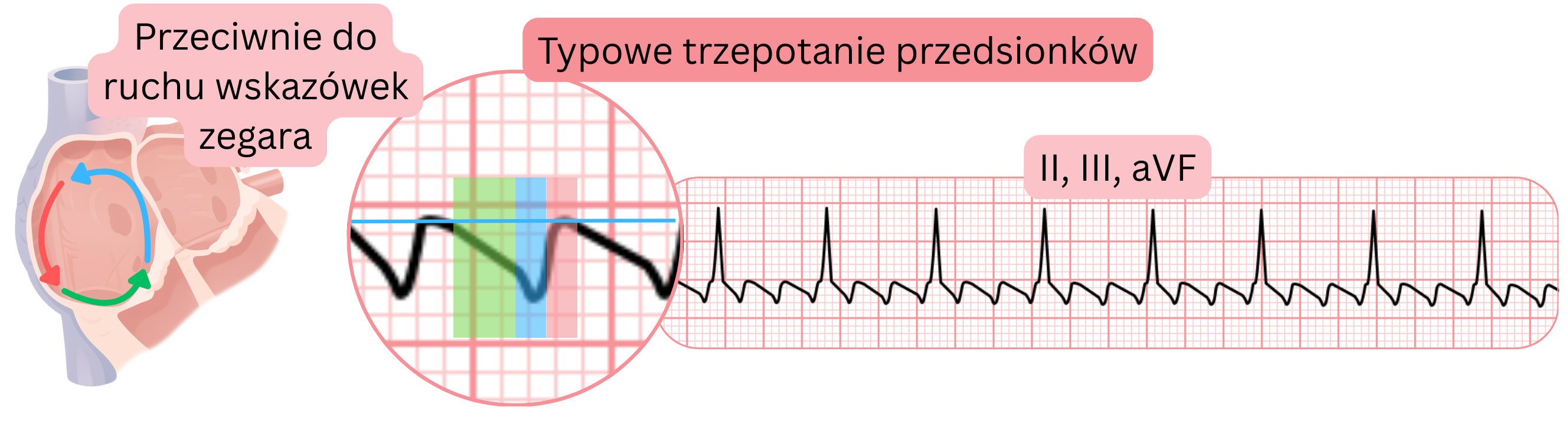 Schemat typowego trzepotania przedsionków z przeciwnym do ruchu wskazówek zegara krążeniem reentry oraz charakterystycznymi piłokształtnymi falami w odprowadzeniach EKG II, III i aVF.