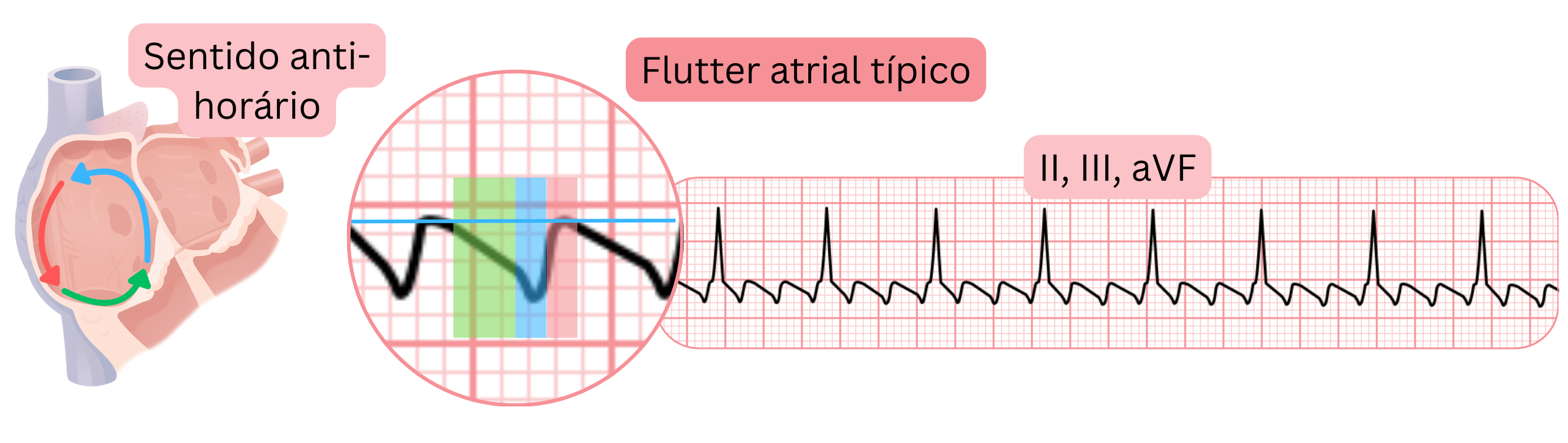 Esquema do flutter atrial típico com circuito de reentrada no sentido anti-horário e ondas de flutter em dente de serra características nas derivações II, III e aVF do ECG.
