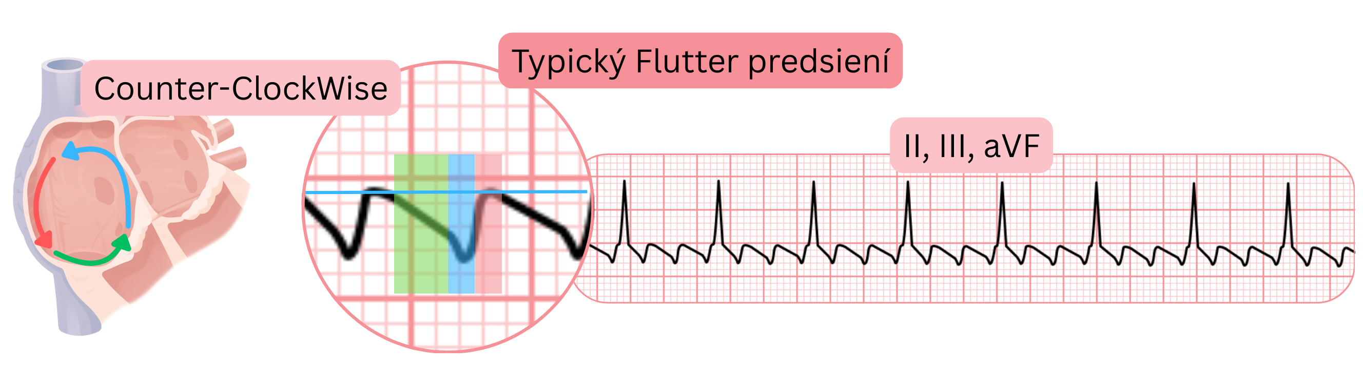 Schéma typického predsieňového flutteru s protihodinovým reentry okruhom a charakteristickými pílovitými vlnami v zvodoch II, III a aVF na EKG.