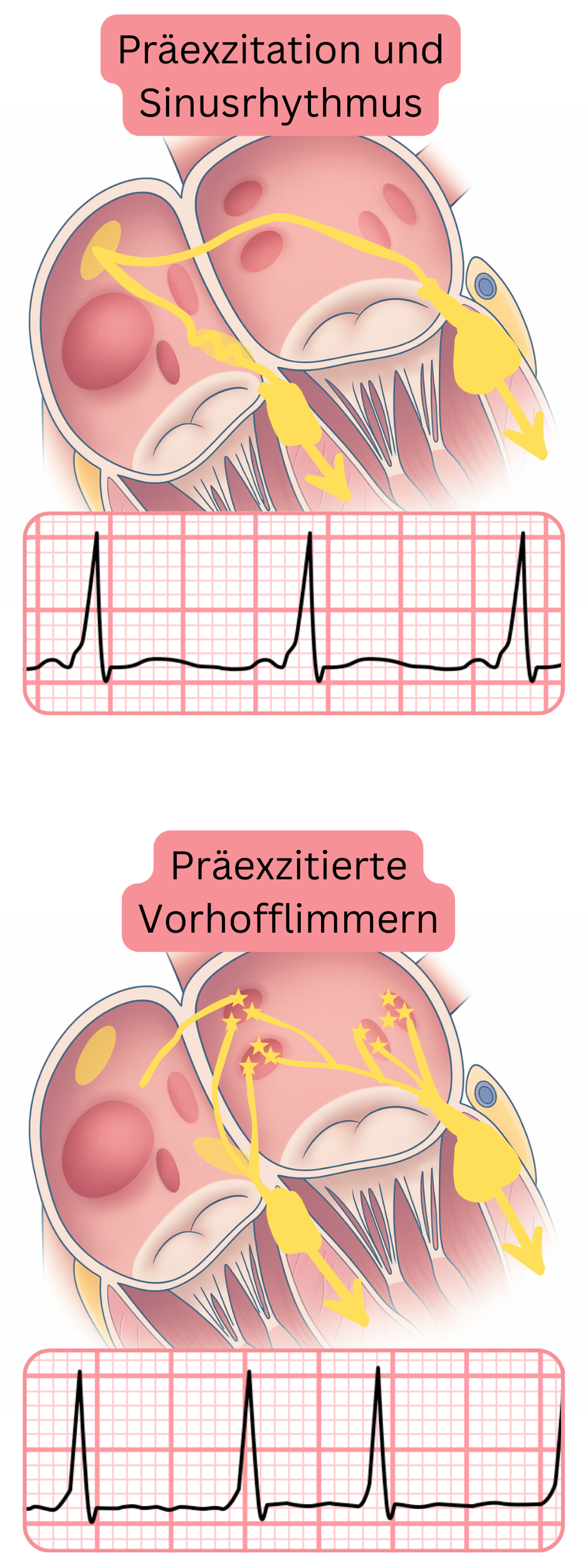 Vergleich der Präexzitation im Sinusrhythmus und des präexzitierten Vorhofflimmerns im EKG.