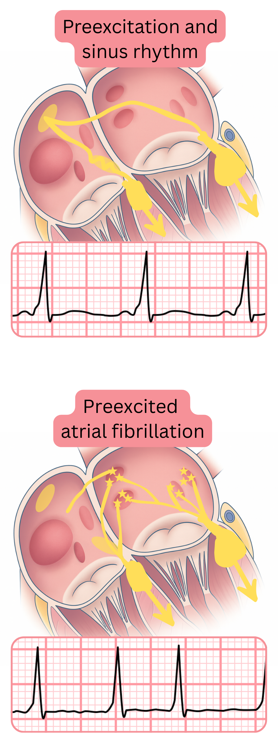 Comparison of preexcitation during sinus rhythm and preexcited atrial fibrillation on ECG.