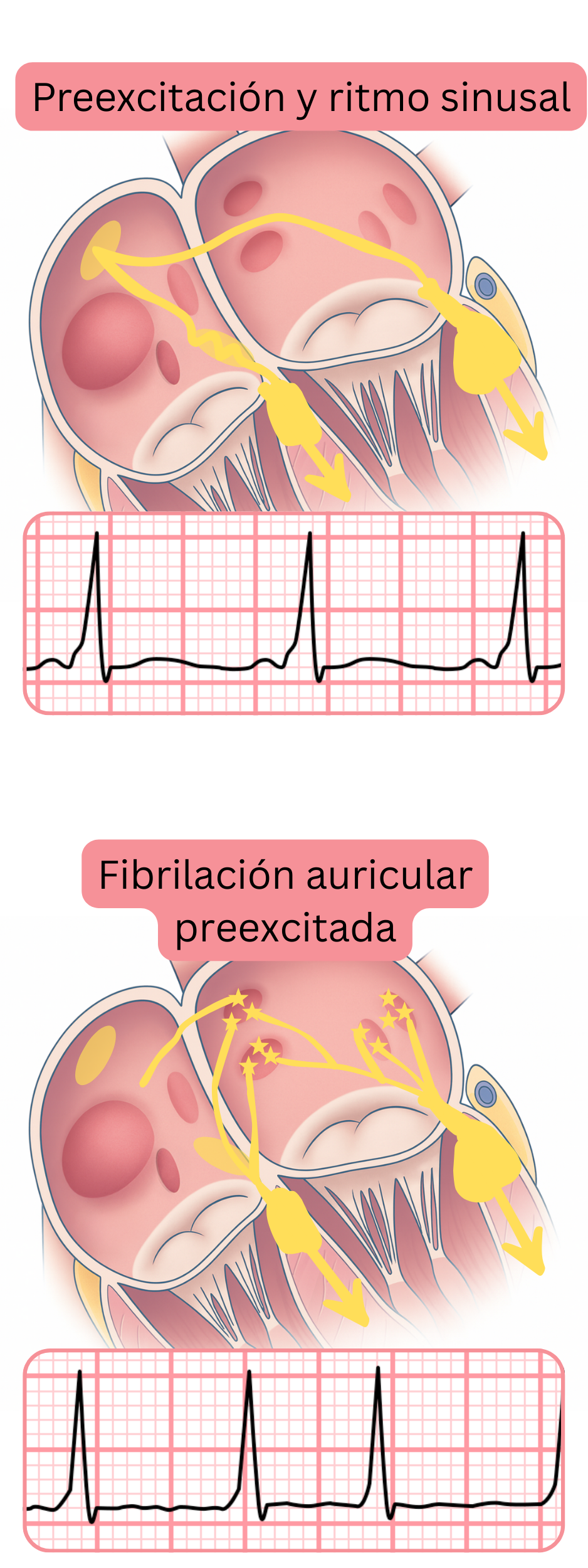 Comparación de la preexcitación en ritmo sinusal y la fibrilación auricular preexcitada en el ECG.
