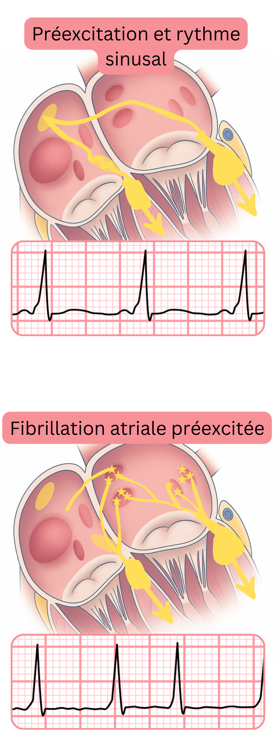 Comparaison de la préexcitation en rythme sinusal et de la fibrillation atriale préexcitée à l’ECG.
