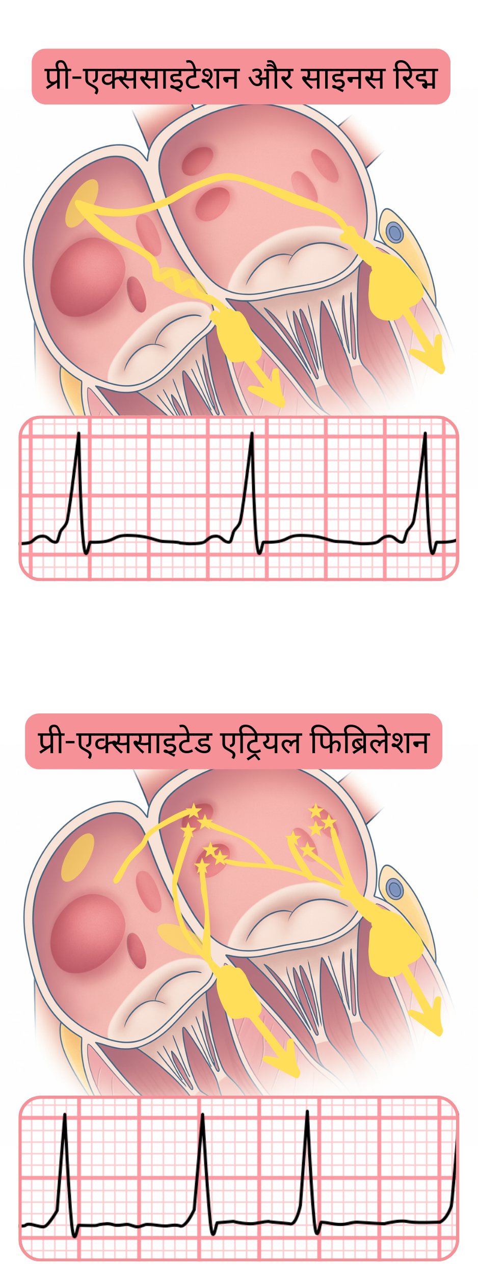 ईसीजी पर साइनस रिद्म के दौरान प्रीएक्साइटेशन और प्रीएक्साइटेड एट्रियल फिब्रिलेशन की तुलना।