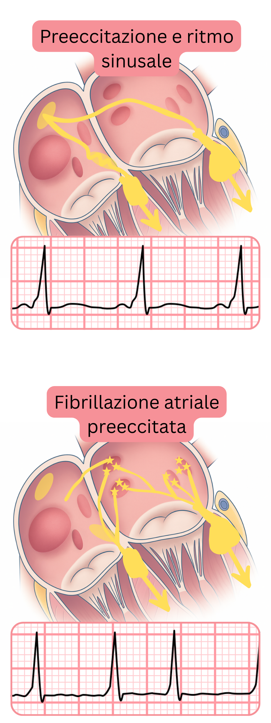 Confronto tra la preeccitazione in ritmo sinusale e la fibrillazione atriale preeccitata all’ECG.