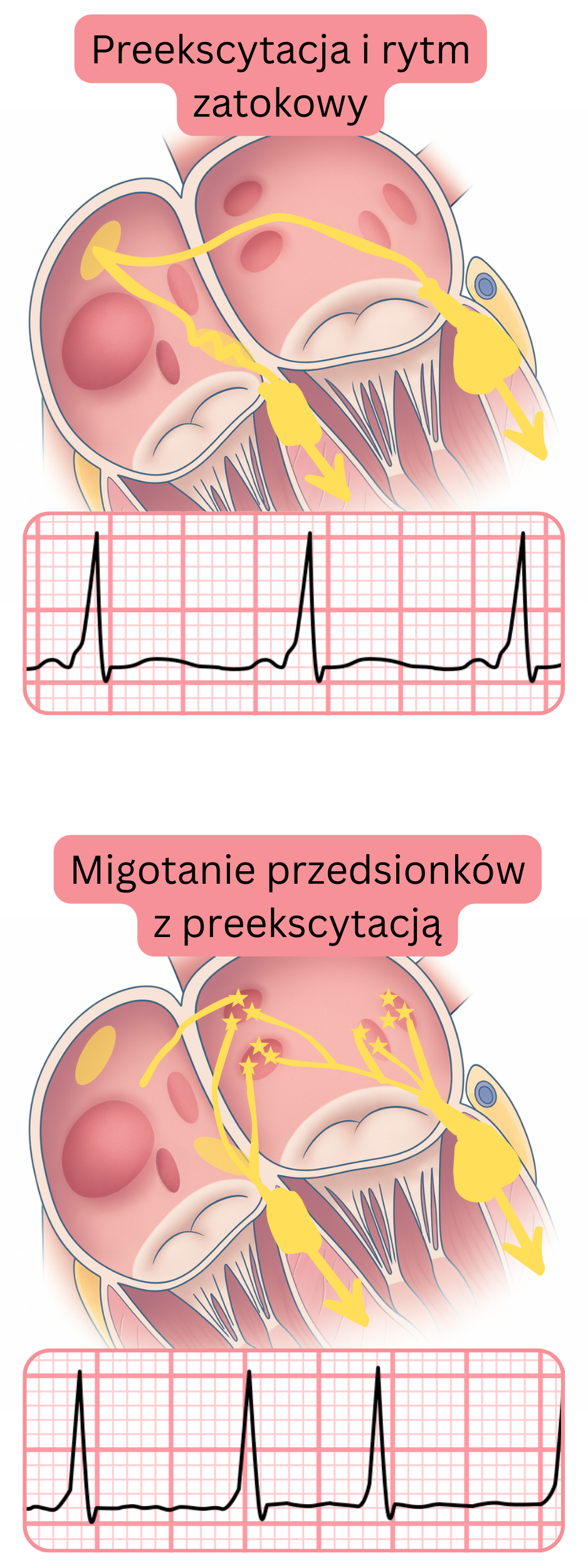 Porównanie preekscytacji w rytmie zatokowym oraz preekscytowanego migotania przedsionków w EKG.