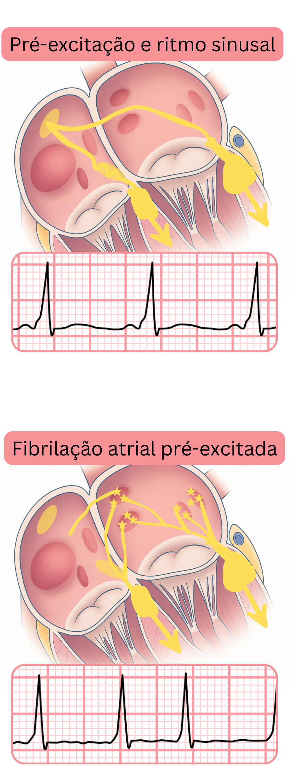 Comparação da pré-excitação em ritmo sinusal e da fibrilação atrial pré-excitada no ECG.