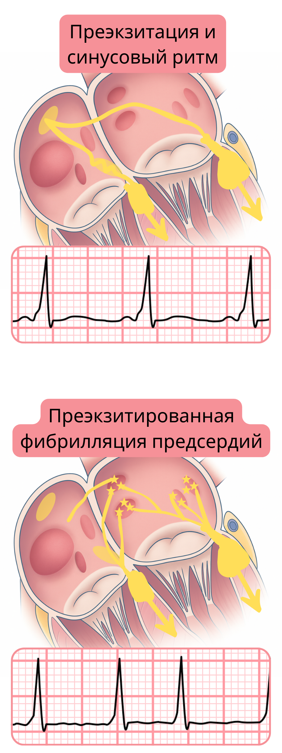 Сравнение предвозбуждения при синусовом ритме и предвозбуждённой фибрилляции предсердий на ЭКГ.