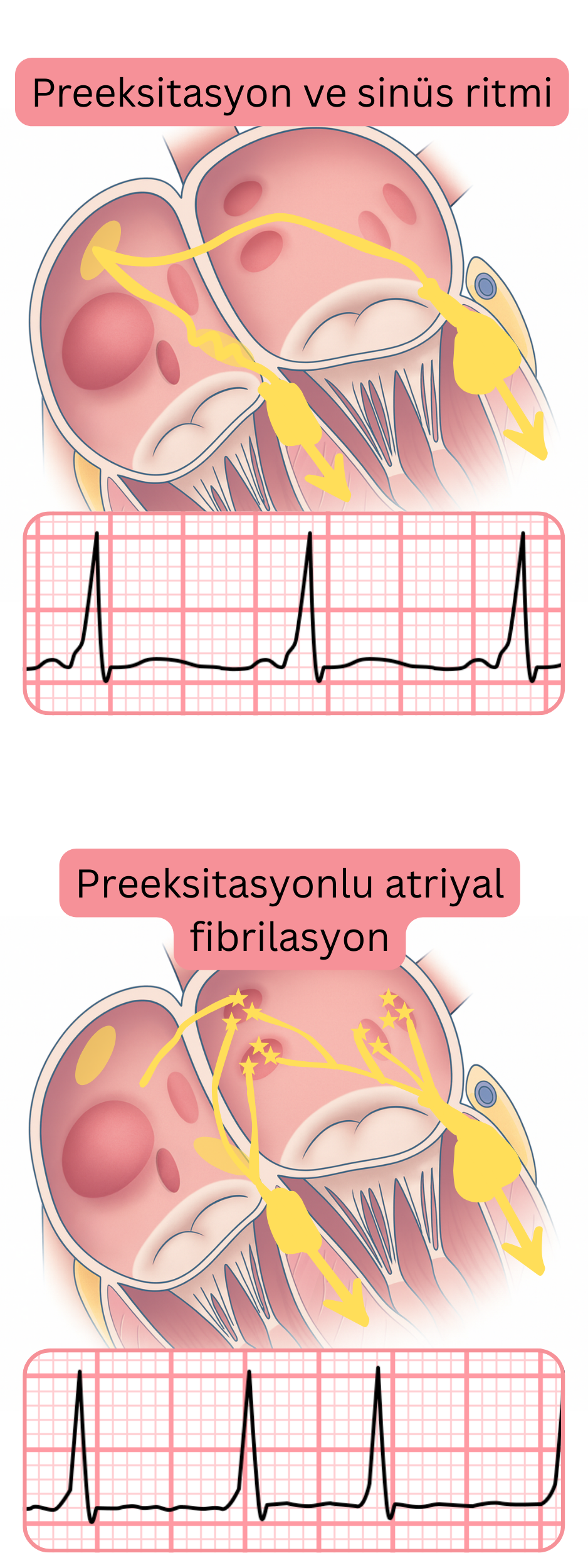EKG’de sinüs ritminde preeksitasyon ile preeksitasyonlu atriyal fibrilasyonun karşılaştırılması.