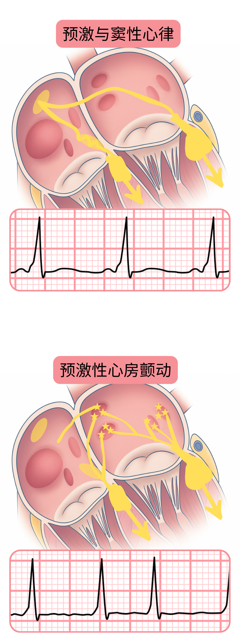 心电图上窦性心律预激与预激性心房颤动的对比示意图。