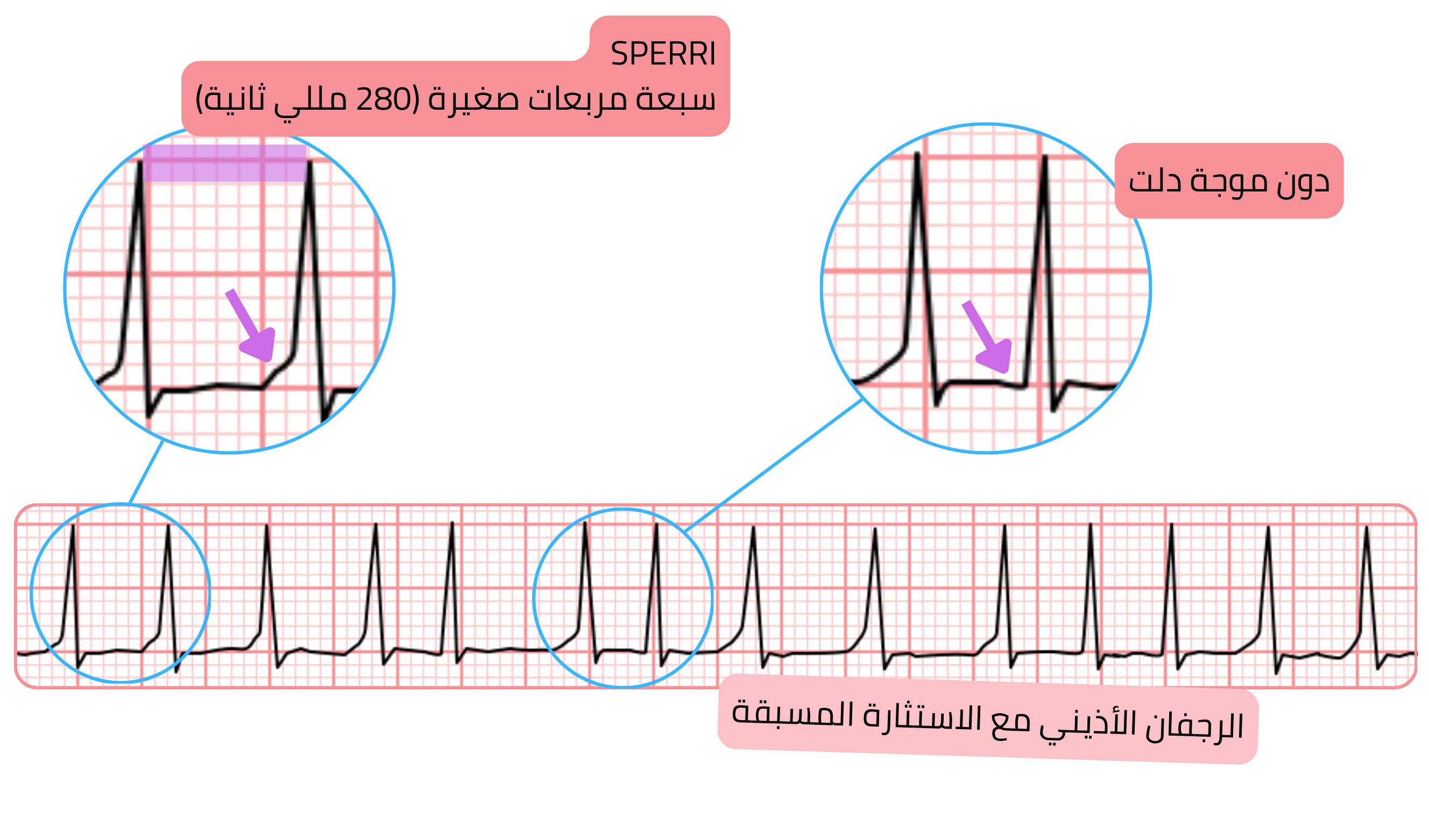 الرجفان الأذيني مع الاستثارة المسبقة مع SPERRI أطول بمقدار 280 مللي ثانية وغياب موجة دلتا على تخطيط القلب.