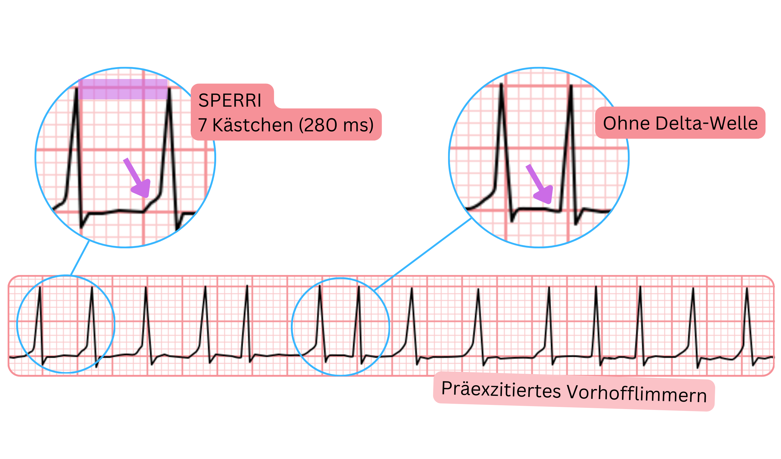 Präexzitiertes Vorhofflimmern mit längerem SPERRI von 280 ms und fehlender Delta-Welle im EKG.
