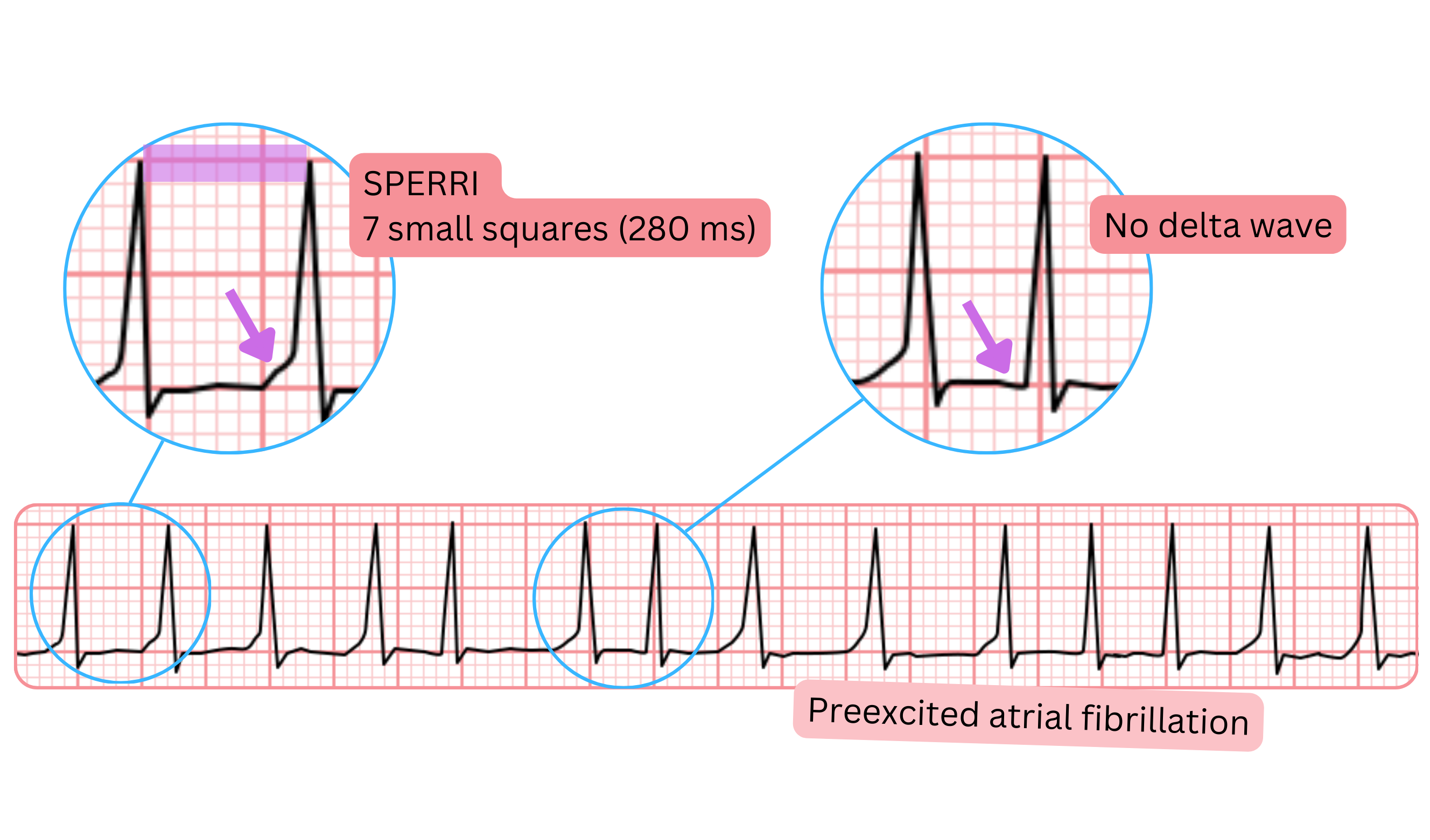 Preexcited atrial fibrillation with a longer SPERRI of 280 ms and absence of delta wave on ECG.