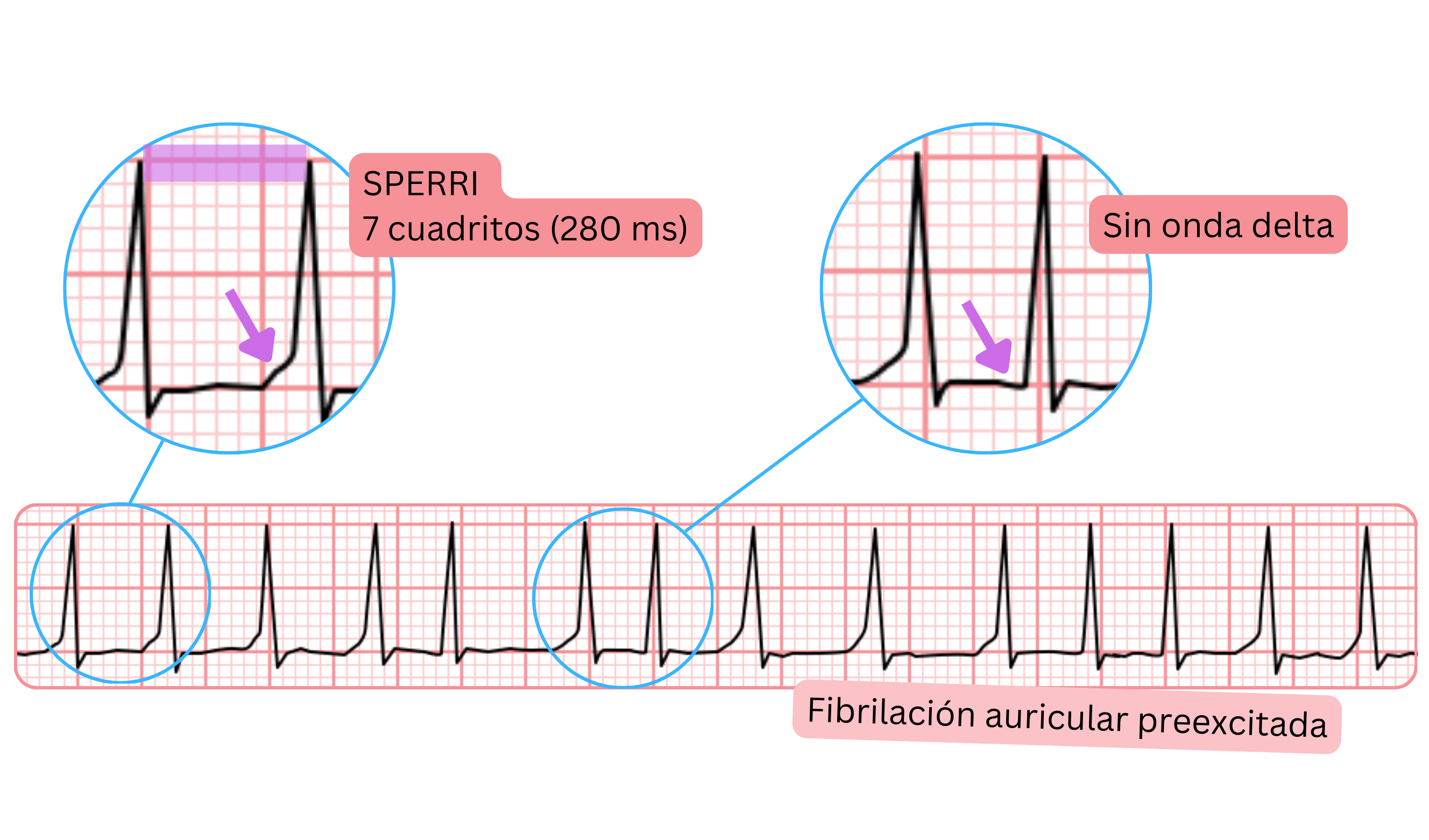 Fibrilación auricular preexcitada con SPERRI más prolongado de 280 ms y ausencia de onda delta en el ECG.